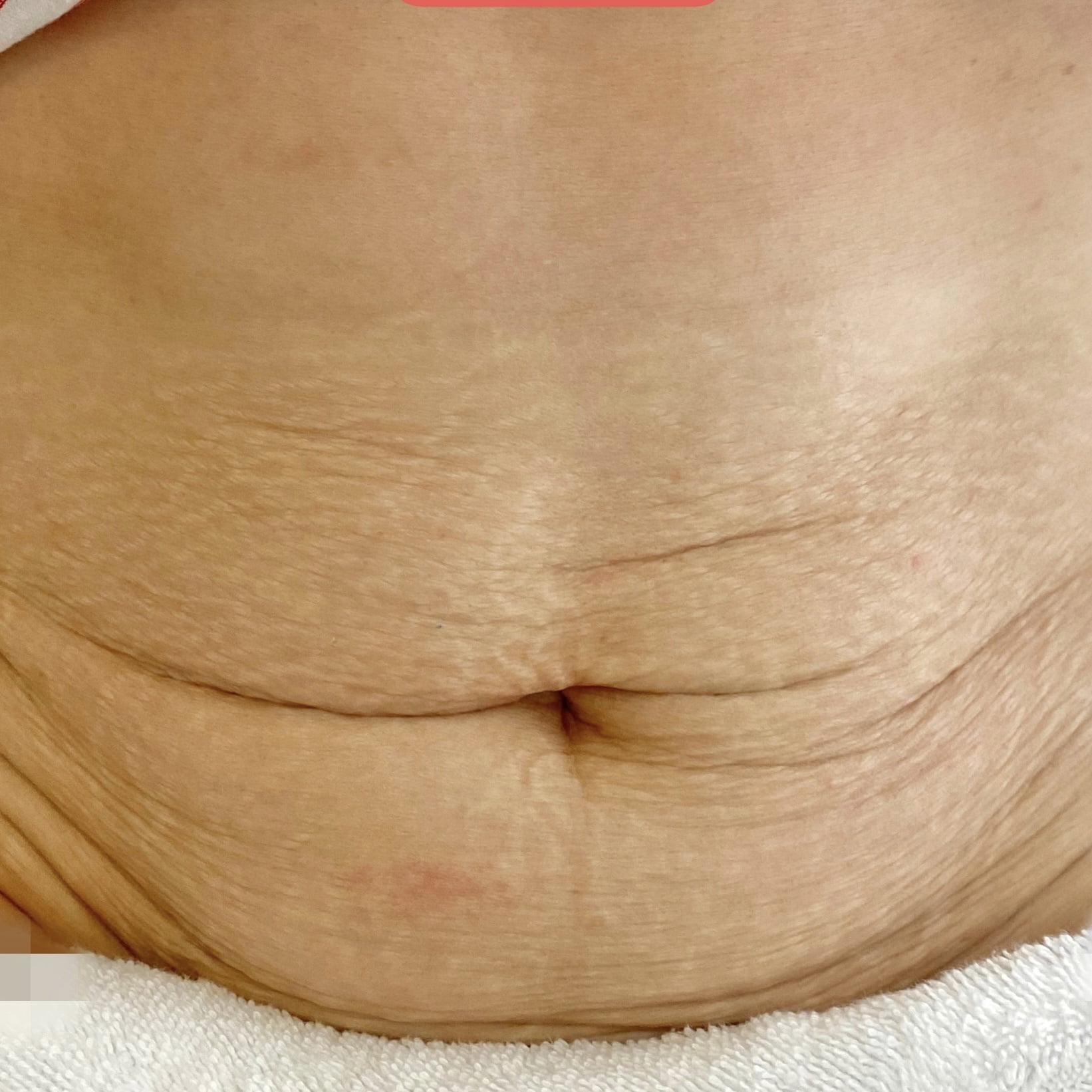 Client before Ultraformer III skin tightening for tummy