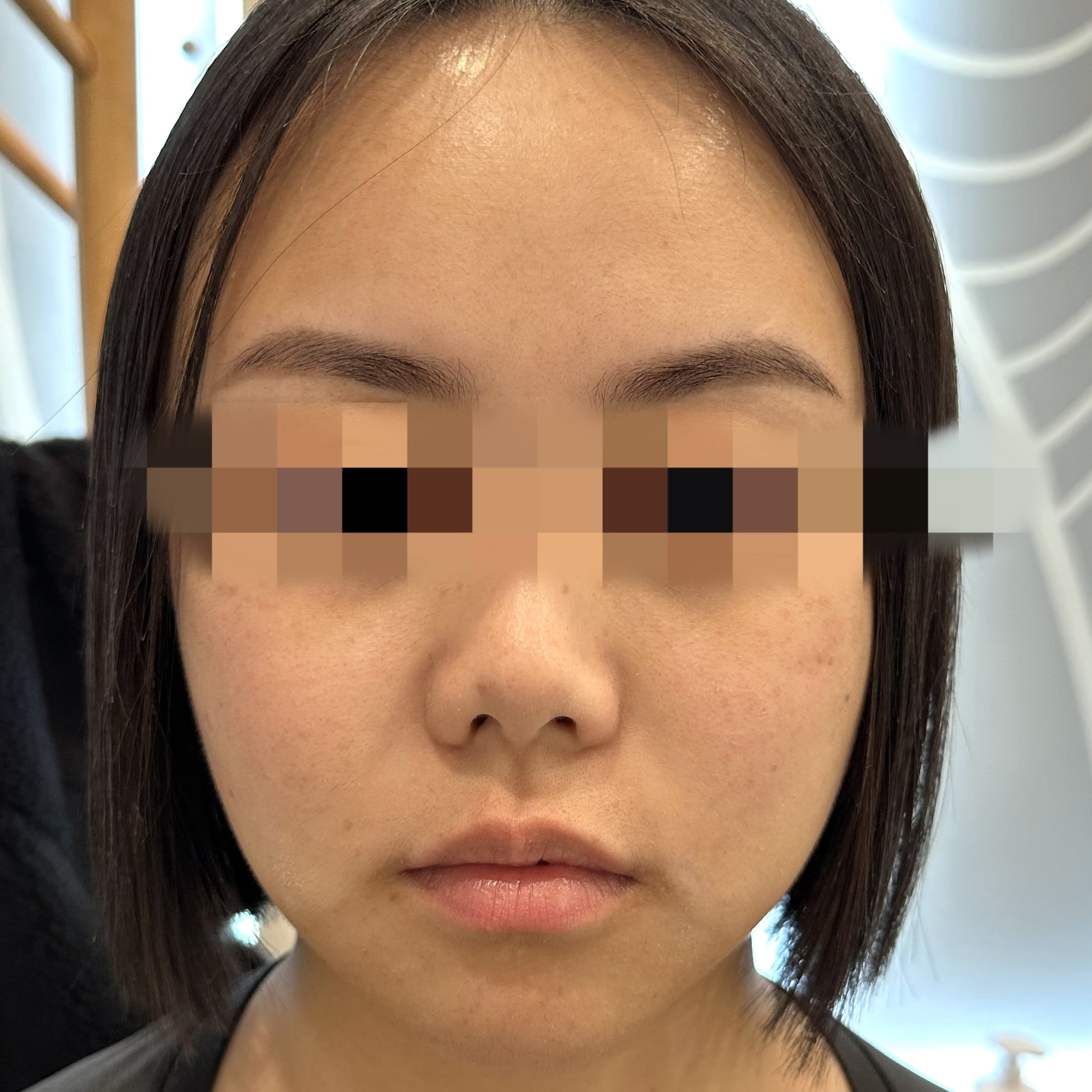 Before a Thermage FLX skin tightening treatment