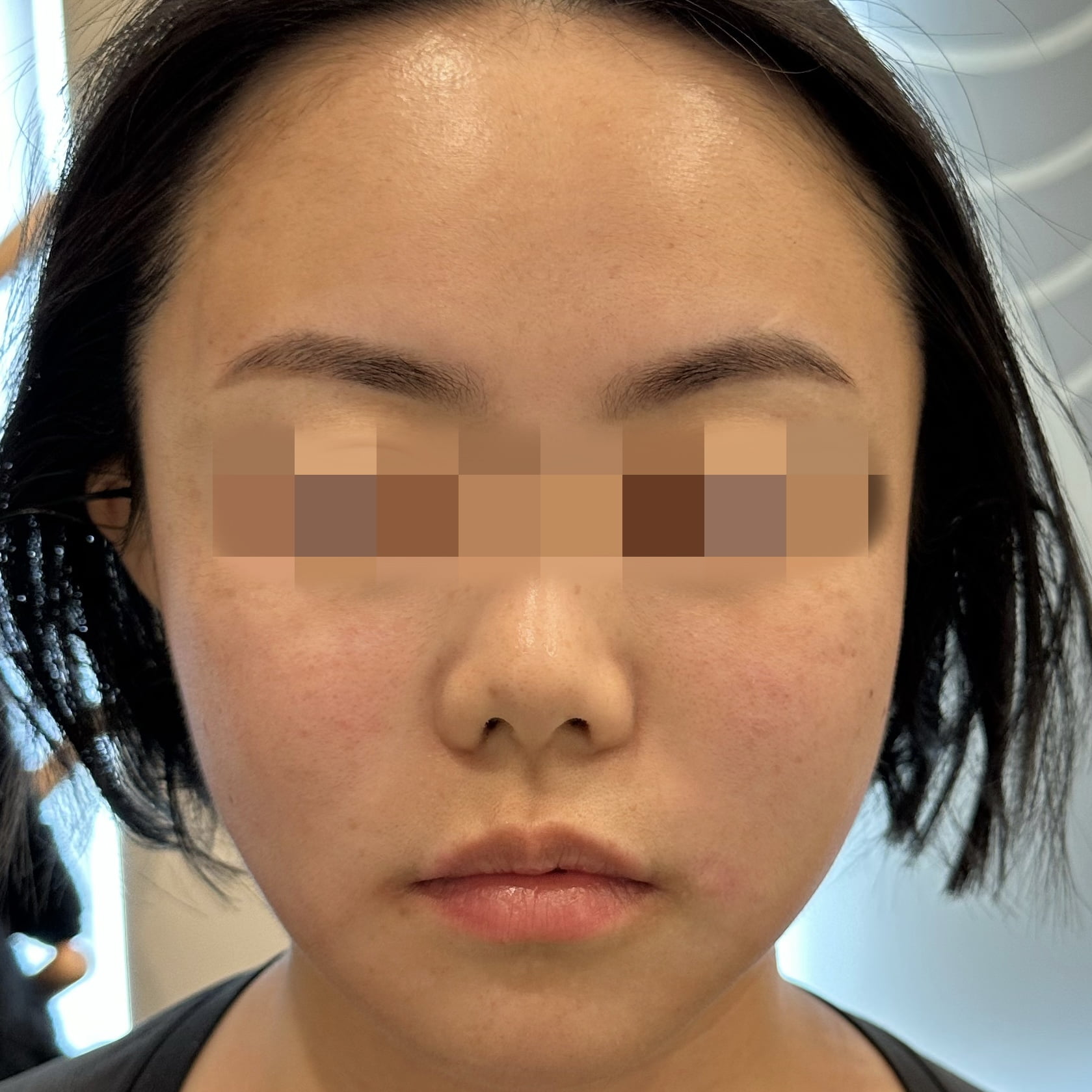 Instantly after one Thermage FLX skin tightening treatment