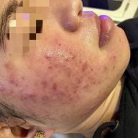Client before 5 Elements Acne Microneedling Facial Treatment