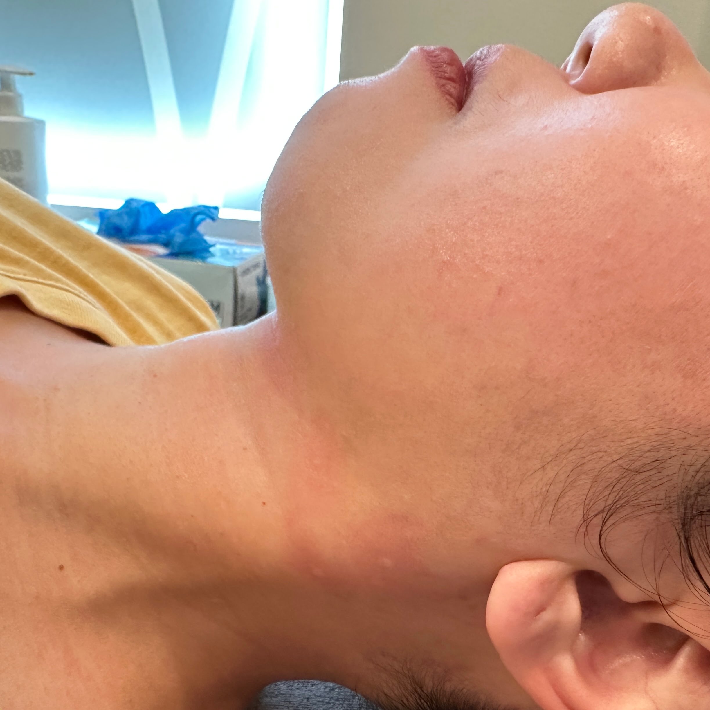 Client after Ultraformer III double chin treatment, with tightened and lifted jaw and skin.
