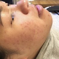 Client after 5 Elements Acne Microneedling Facial Treatment with reduced acne