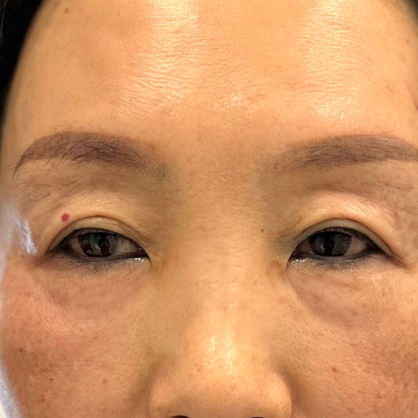 Client results instantly after 1 session Thermage Barbie Eye treatment