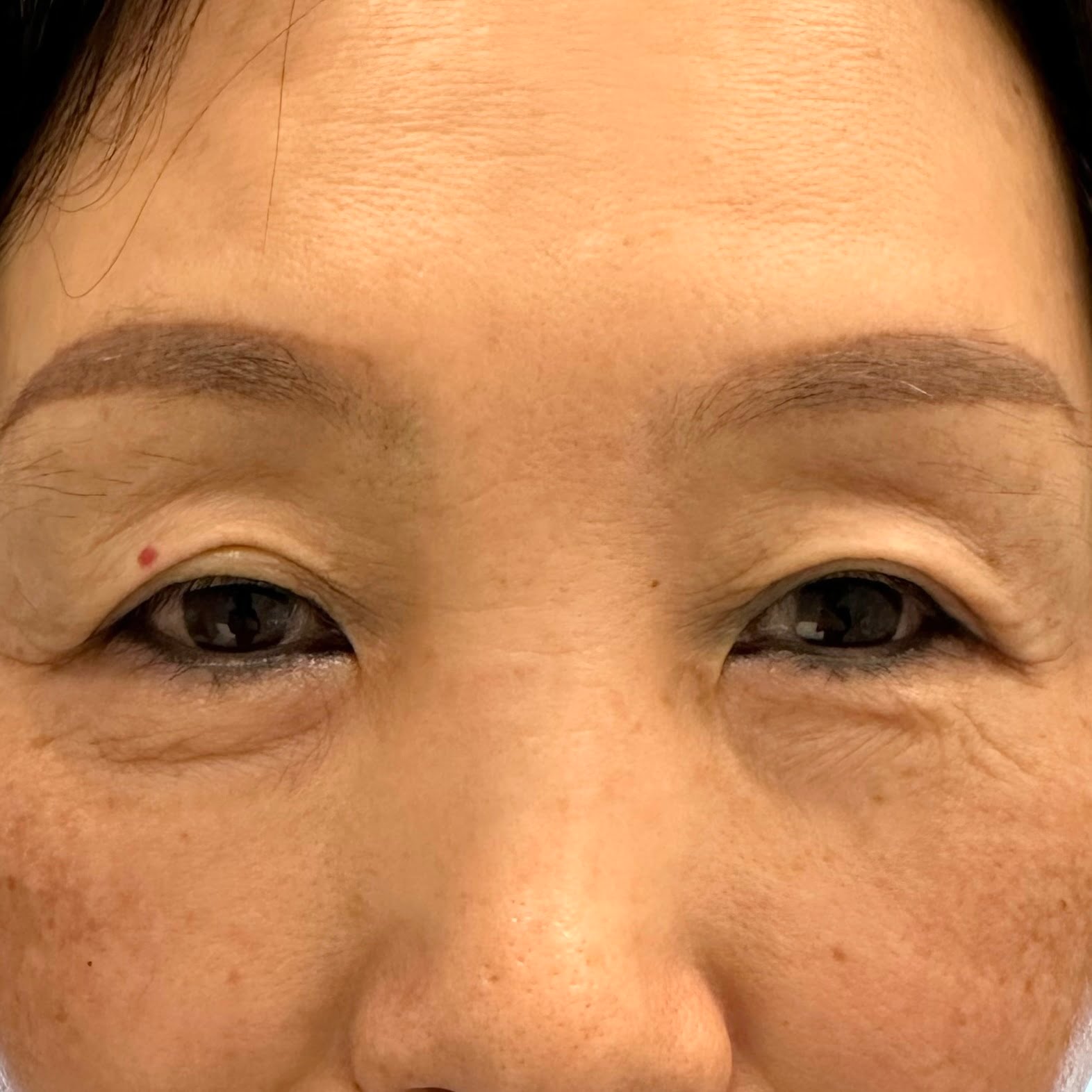 Client before Thermage Barbie Eye treatment