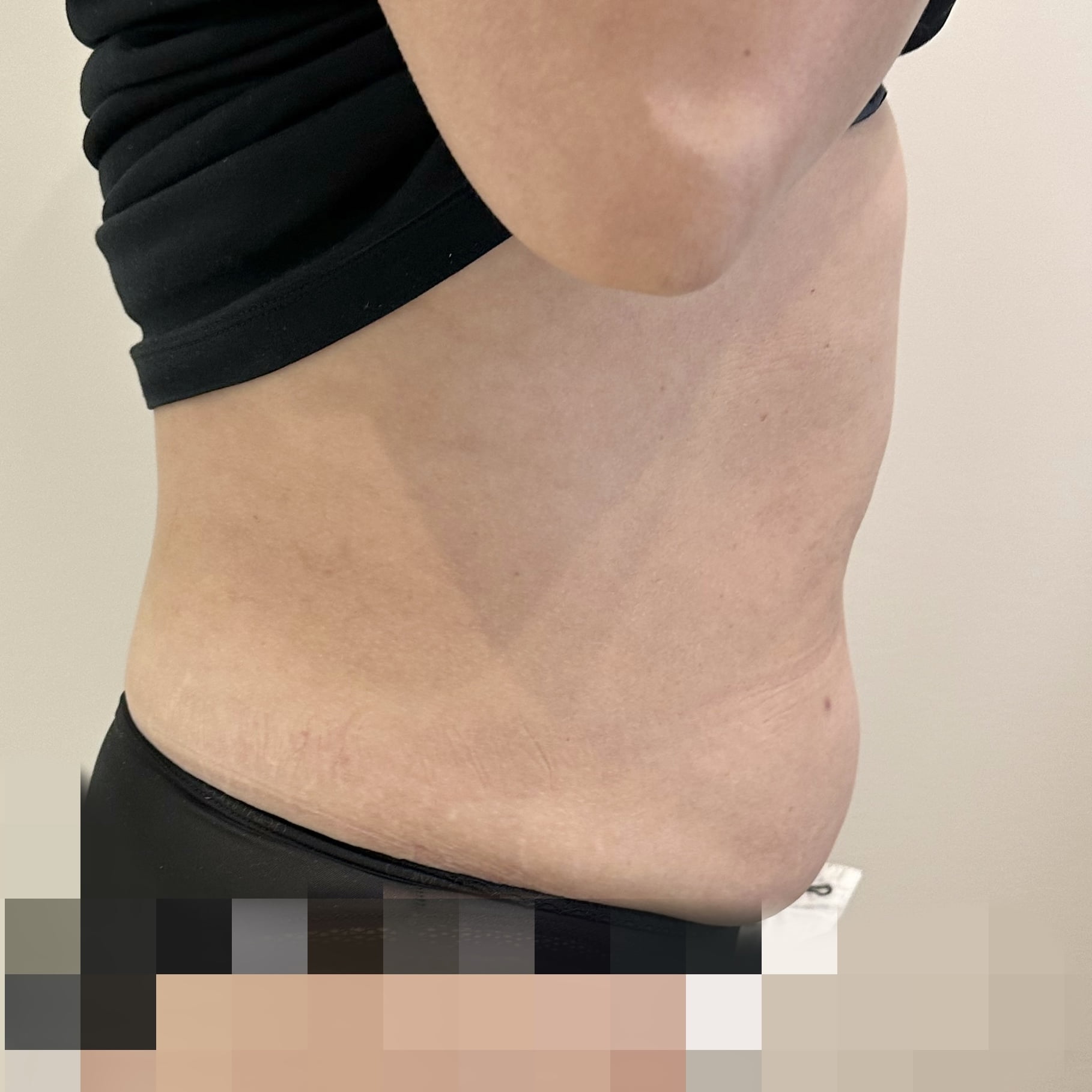 Client before Ultraformer III skin tightening for tummy