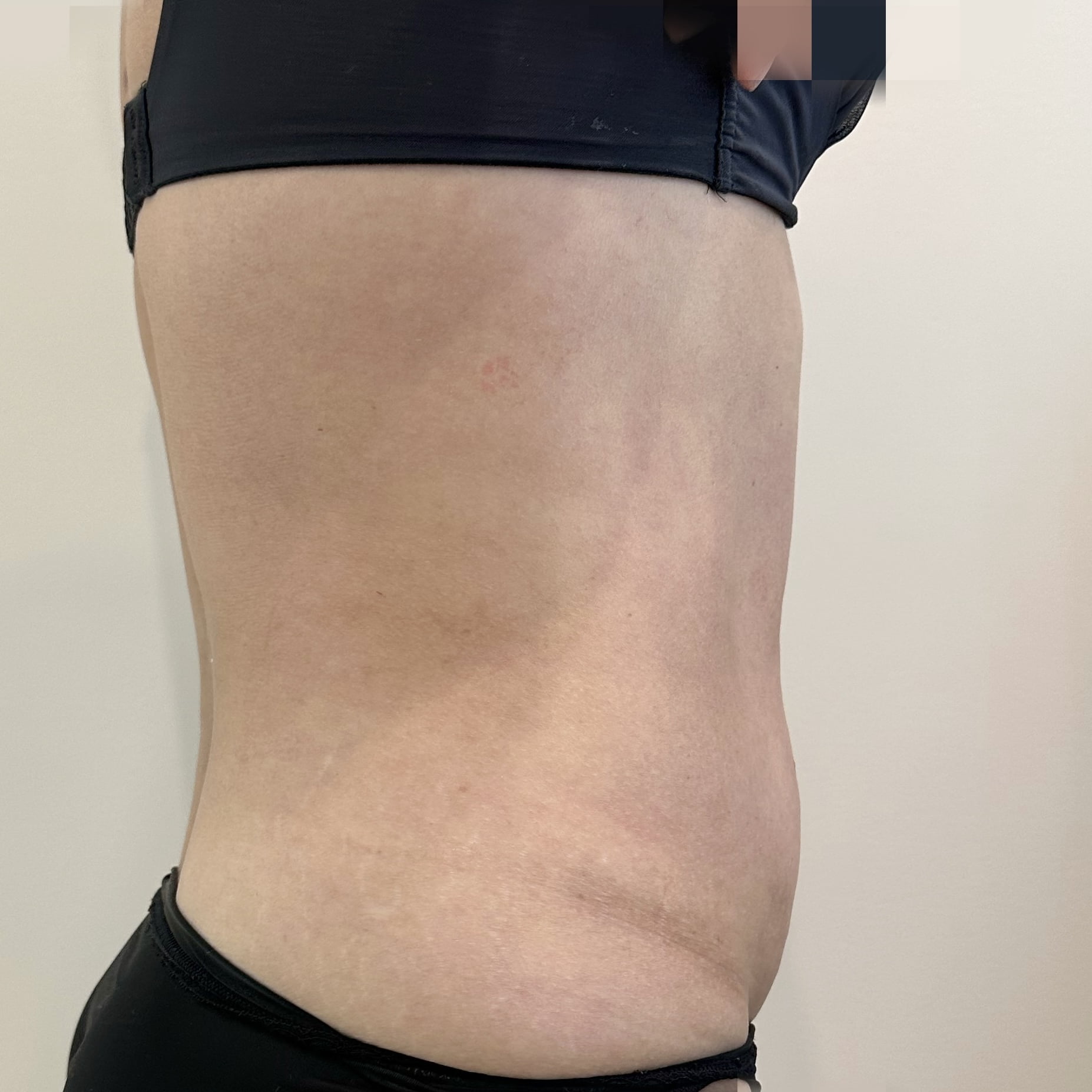Client after 1 session of Ultraformer III skin tightening for tummy