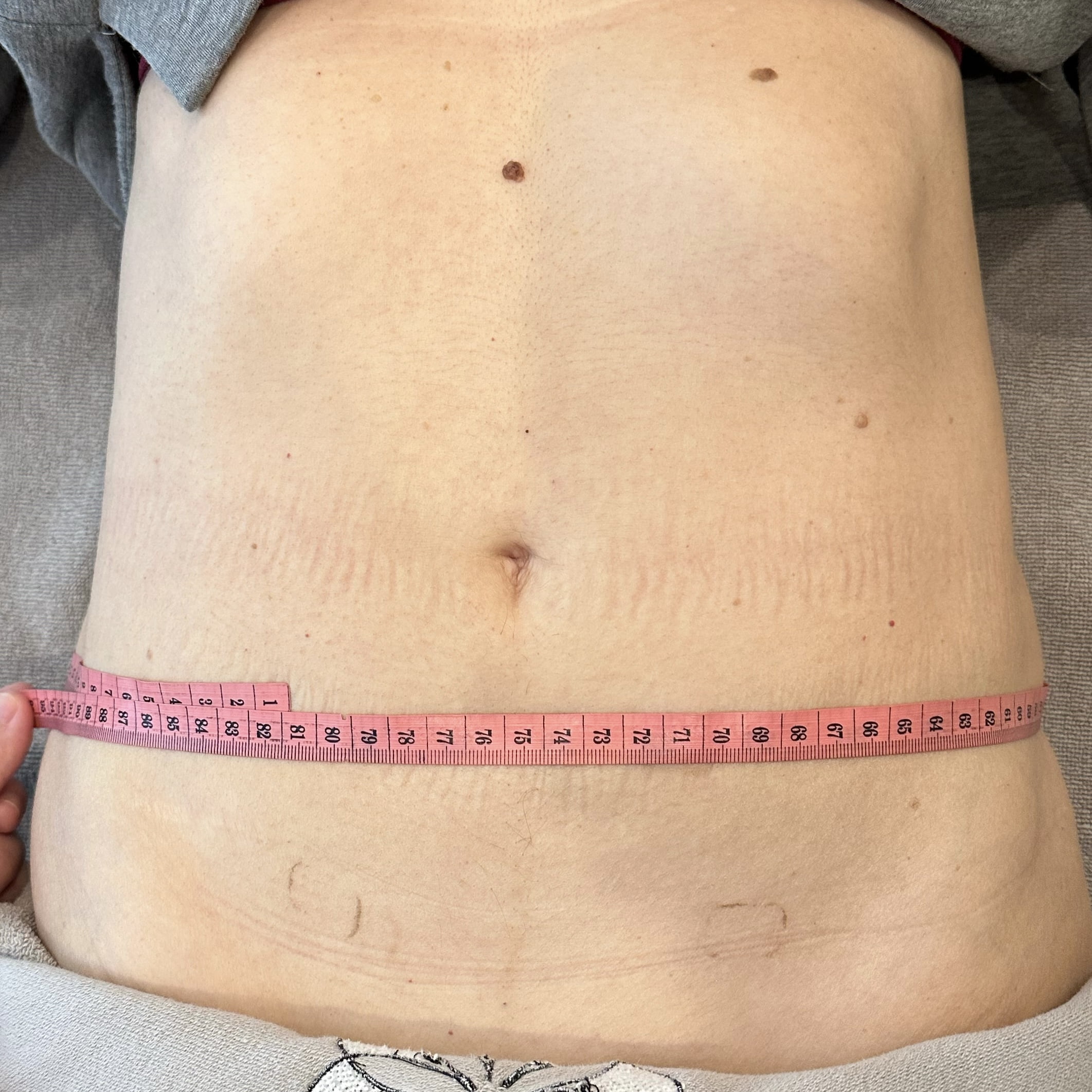 Client before Ultraformer III skin tightening for tummy