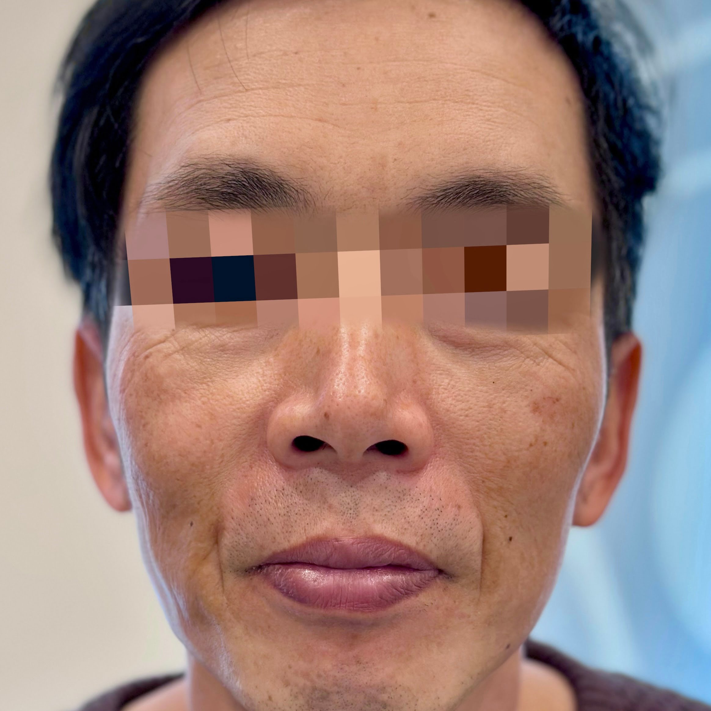 Before a Thermage FLX skin tightening treatment