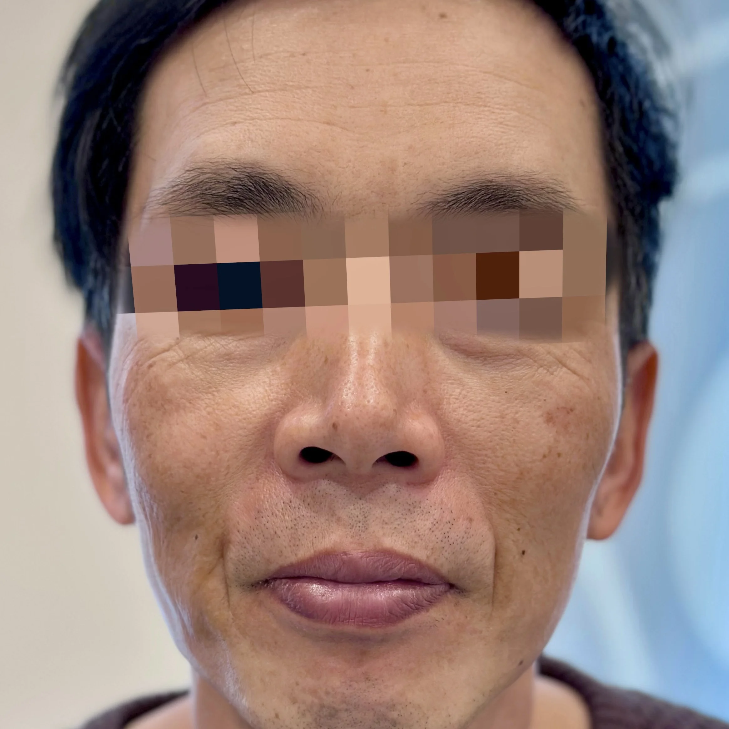 Before a Thermage FLX skin tightening treatment