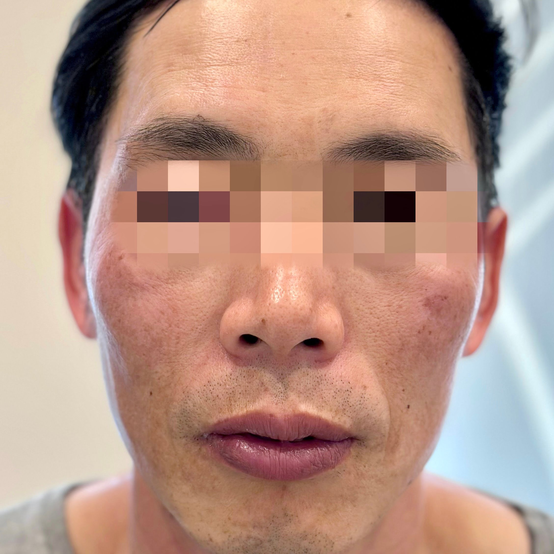 Instantly after one Thermage FLX skin tightening treatment