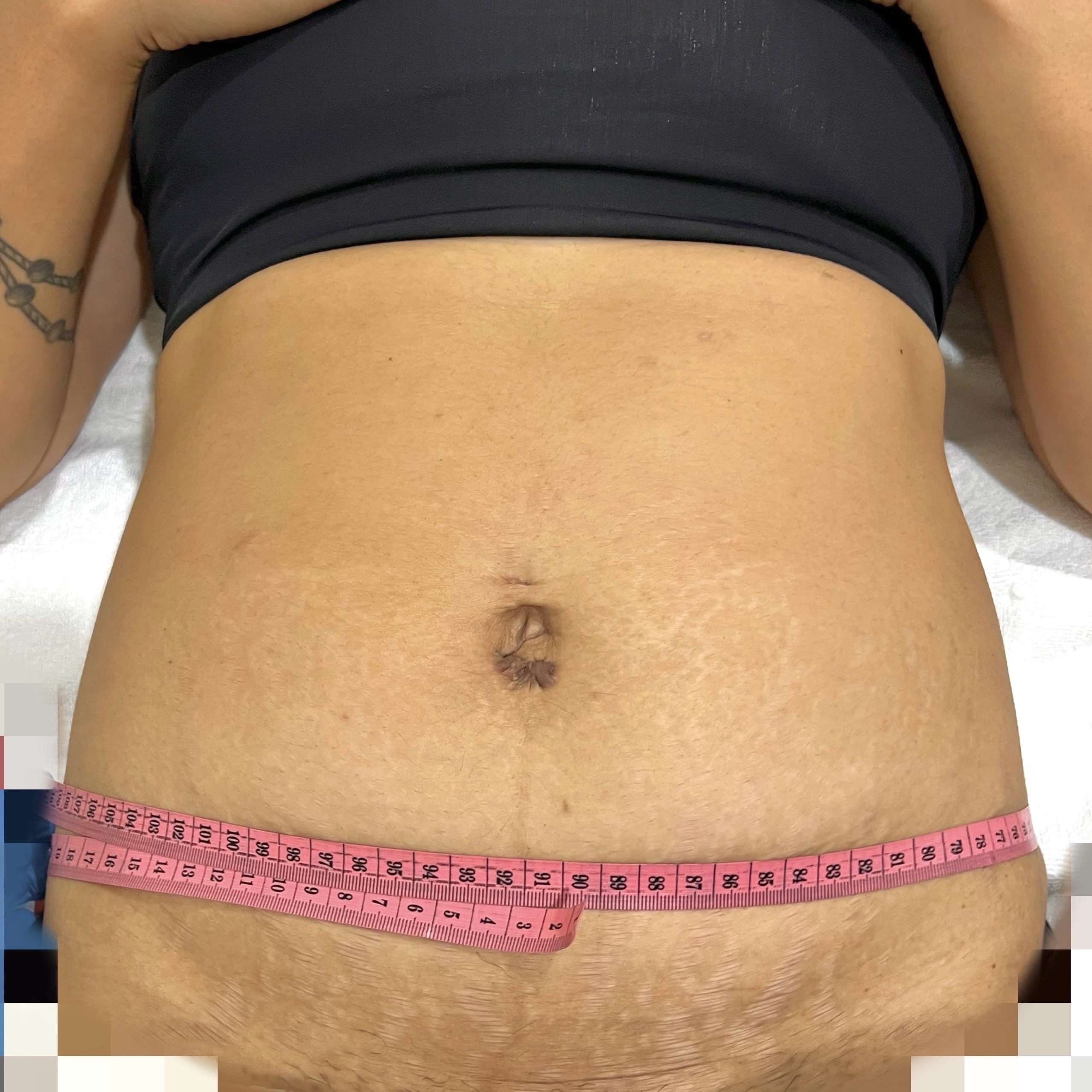 Client before Ultraformer III skin tightening for tummy