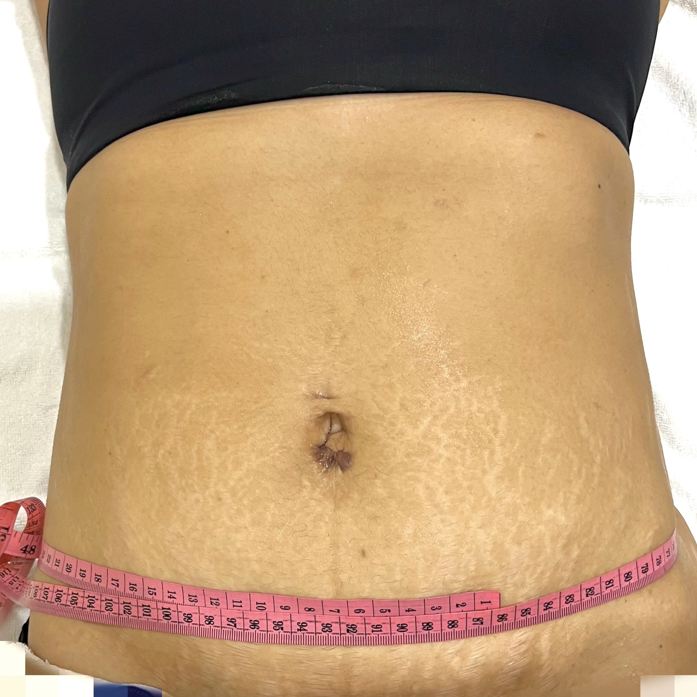 Client after 1 session of Ultraformer III skin tightening for tummy