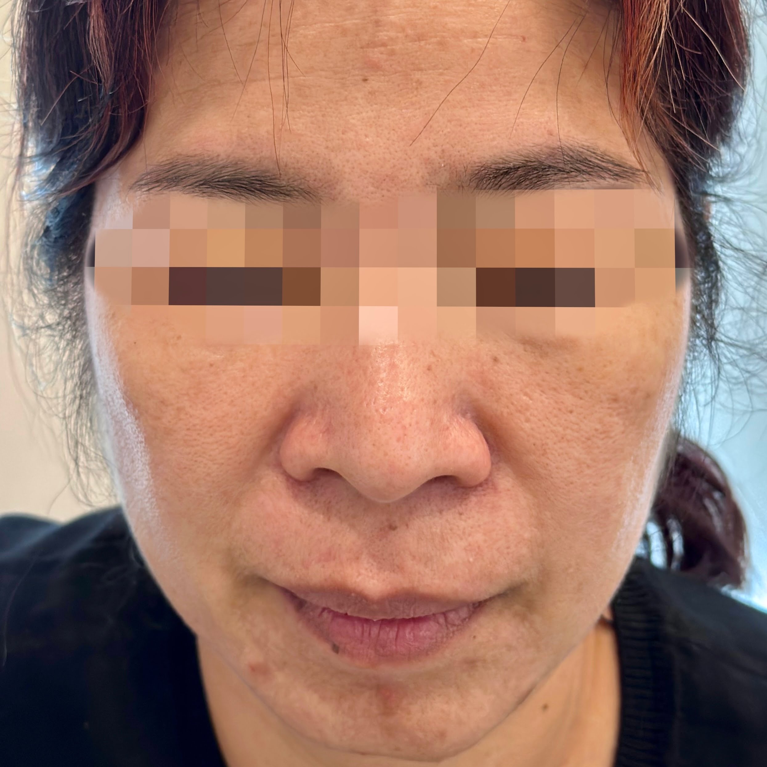 Client before Ultraformer III face lifting and tightening.