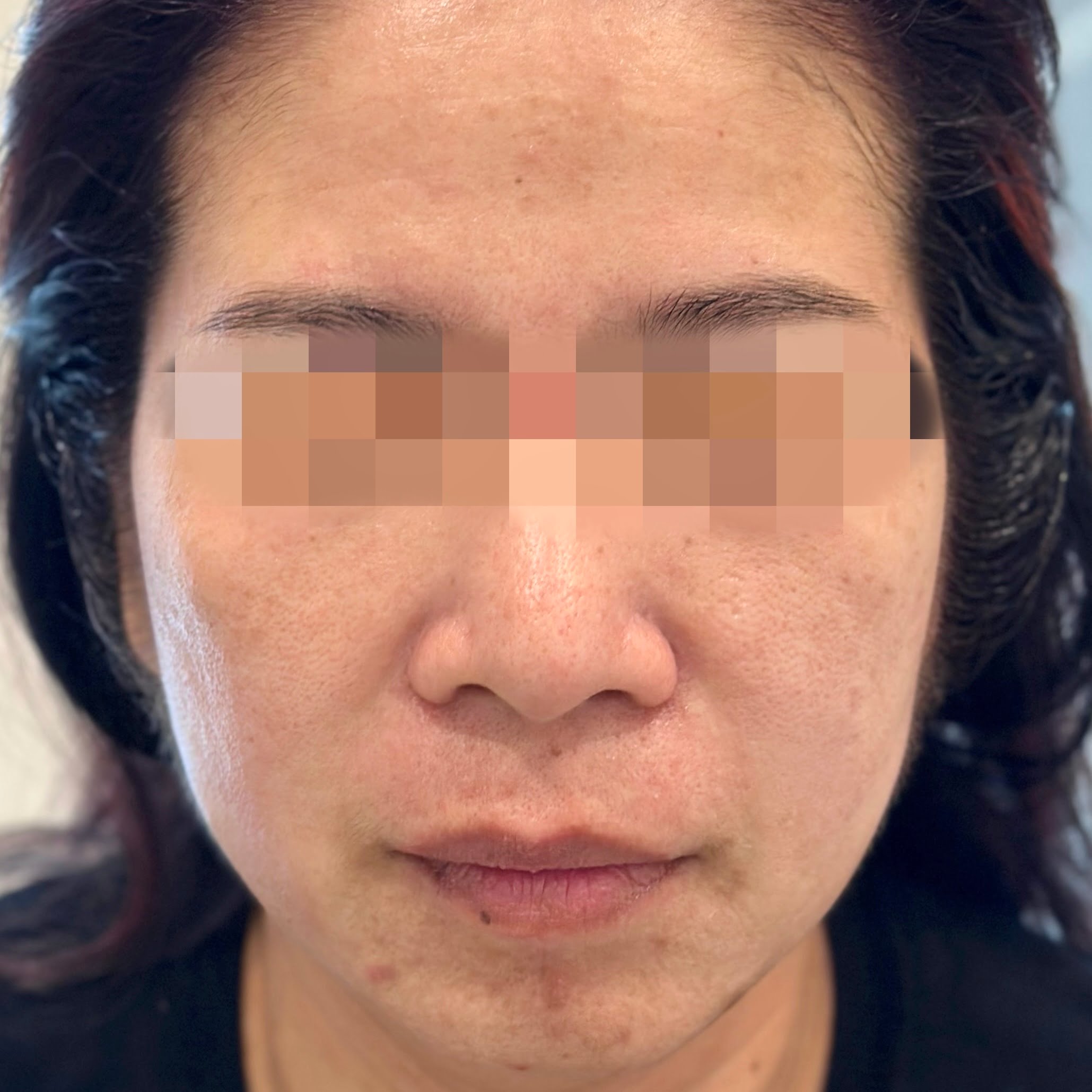 Client after Ultraformer III treatment, with tightened and lifted face and skin.