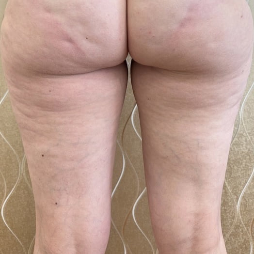 Before NuEra Cellulite Reduction