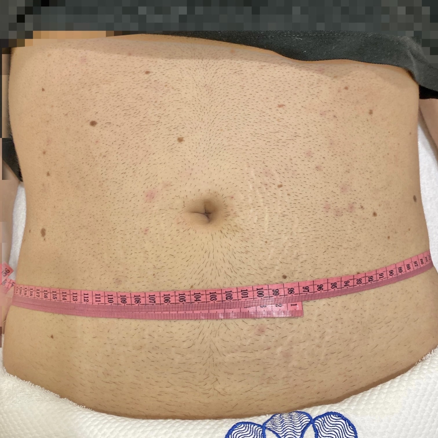 Client before Ultraformer III skin tightening for tummy
