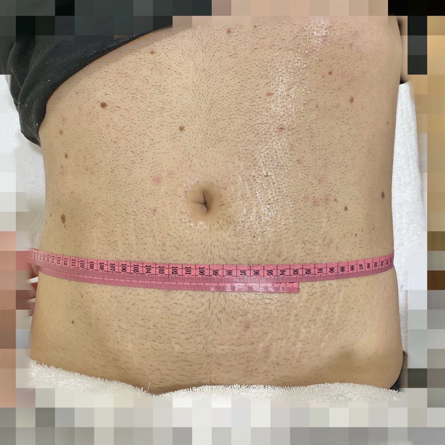 Client after 1 session of Ultraformer III skin tightening for tummy