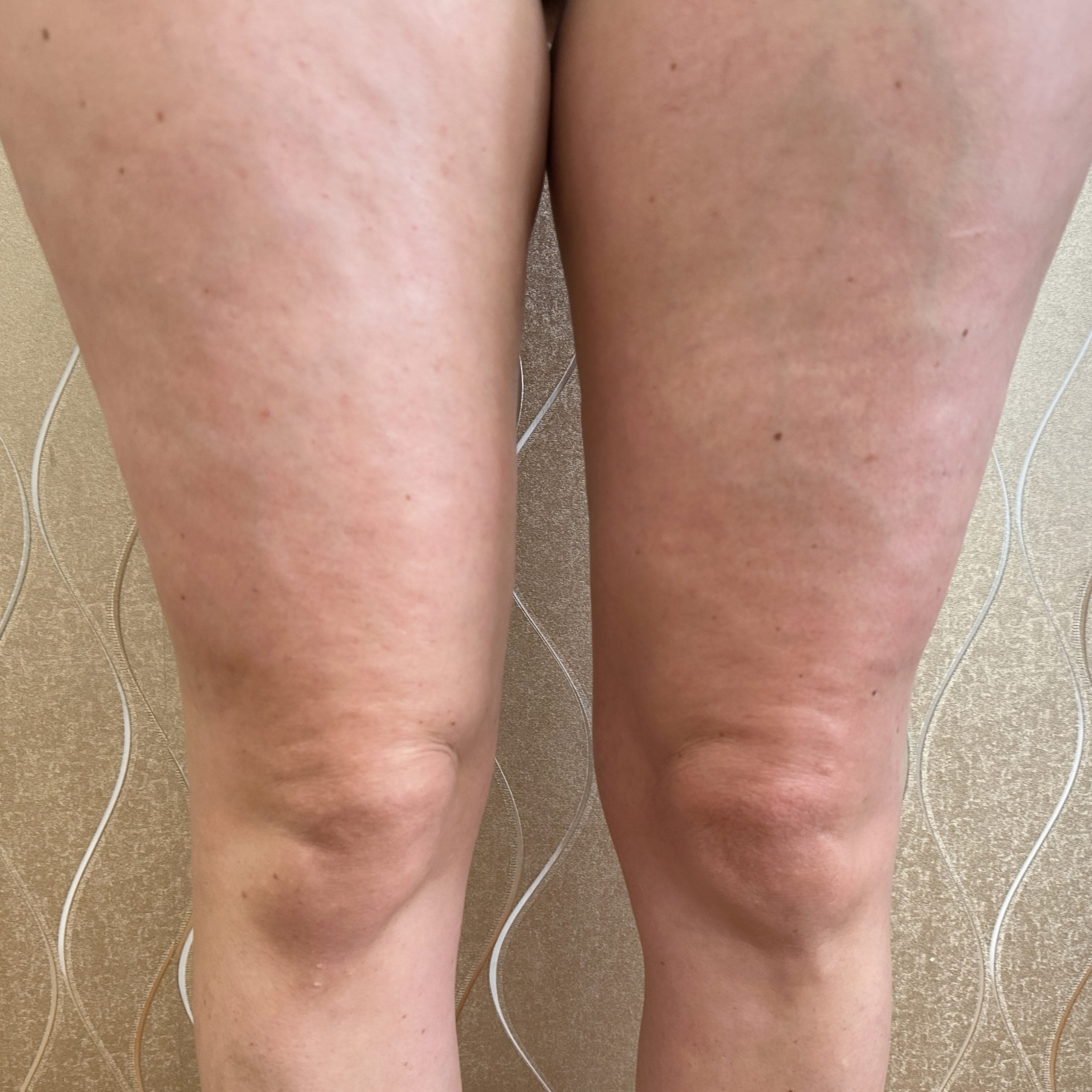 After 3 sessions of NuEra cellulite reduction