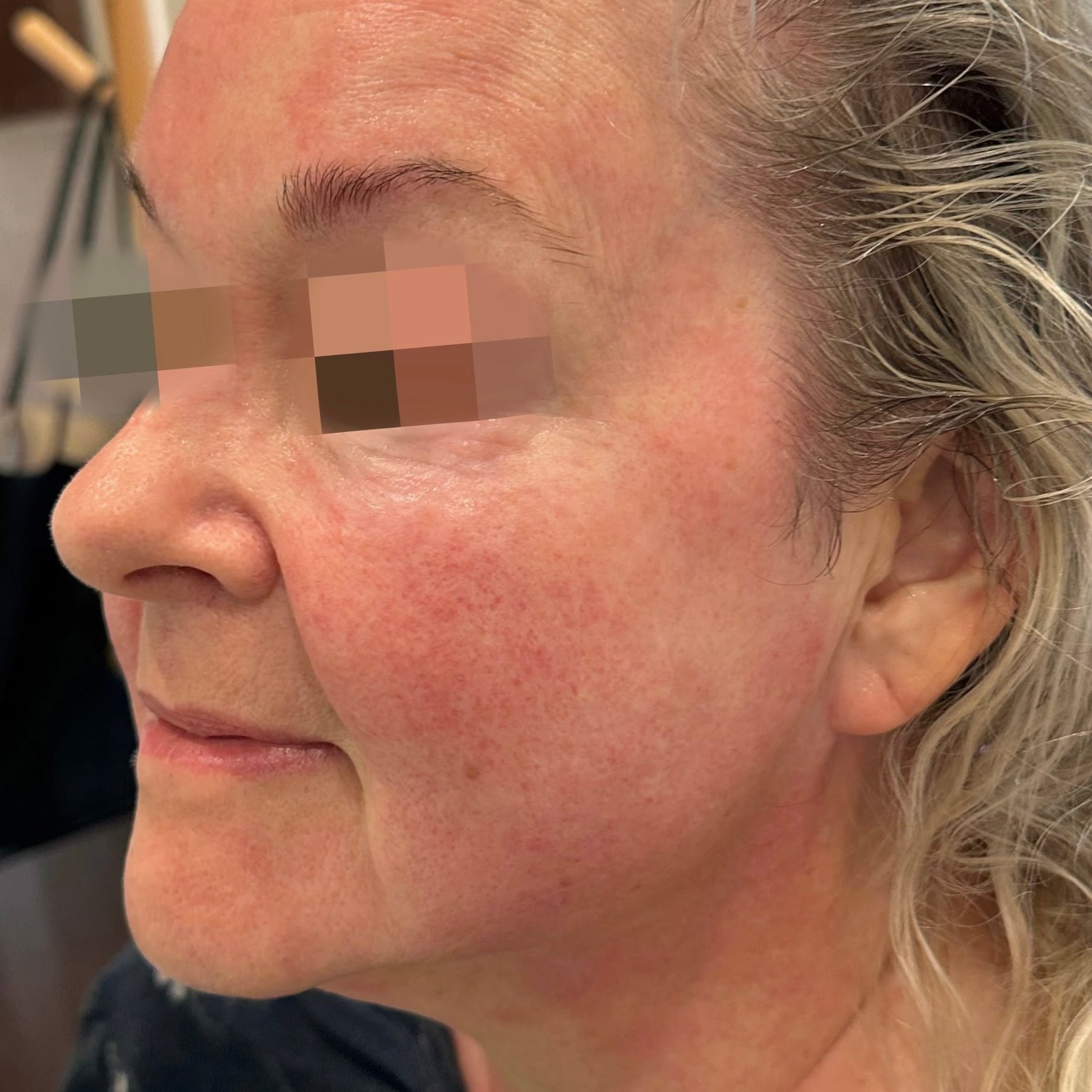 Client after Ultraformer III treatment, with tightened and lifted face and skin.