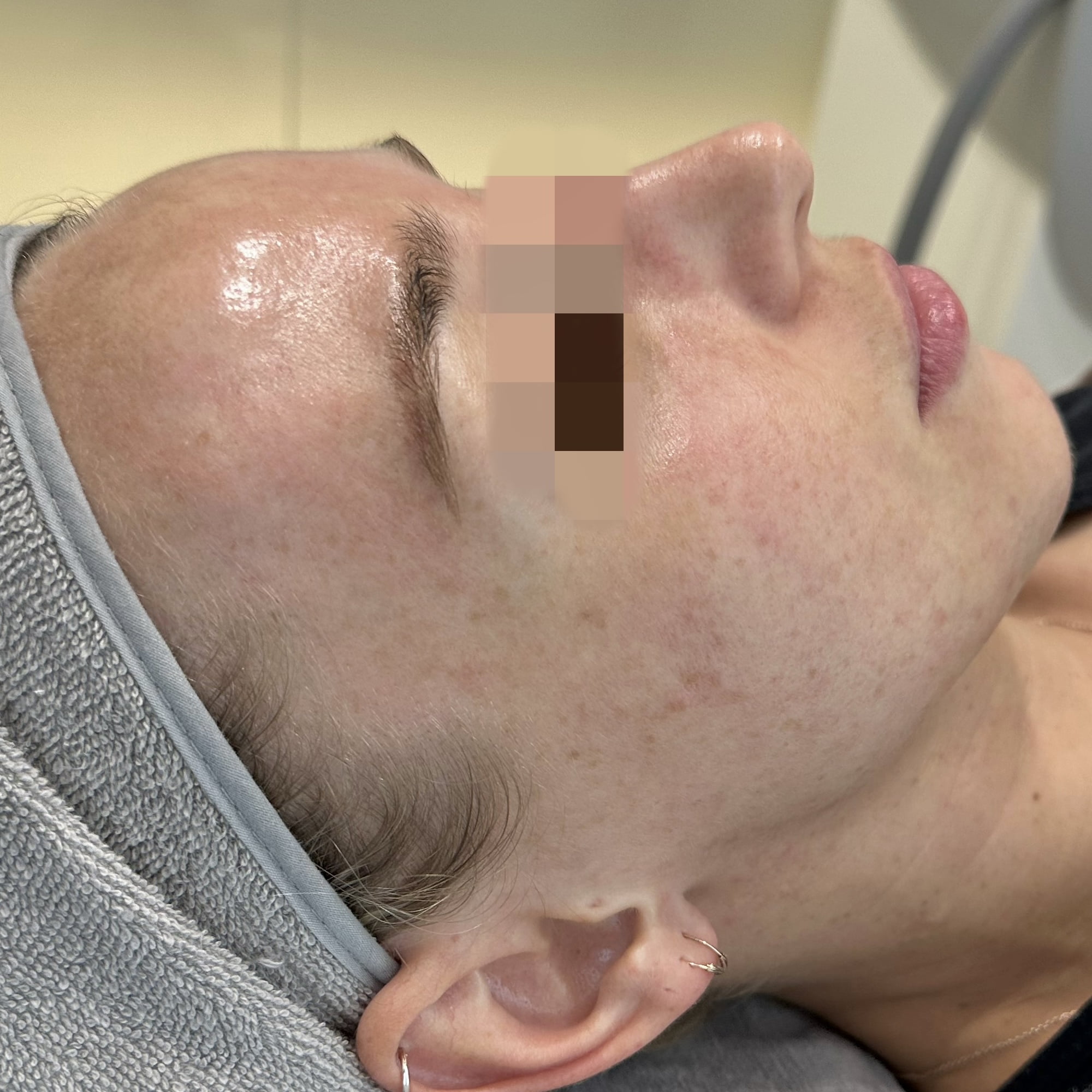 Client after 1 session of Dermashine Meostherapy Acne Banish Injection