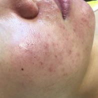 Client before 5 Elements Acne Microneedling Facial Treatment