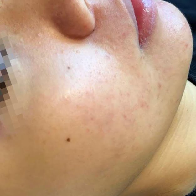 Client after 5 Elements Acne Microneedling Facial Treatment with reduced acne