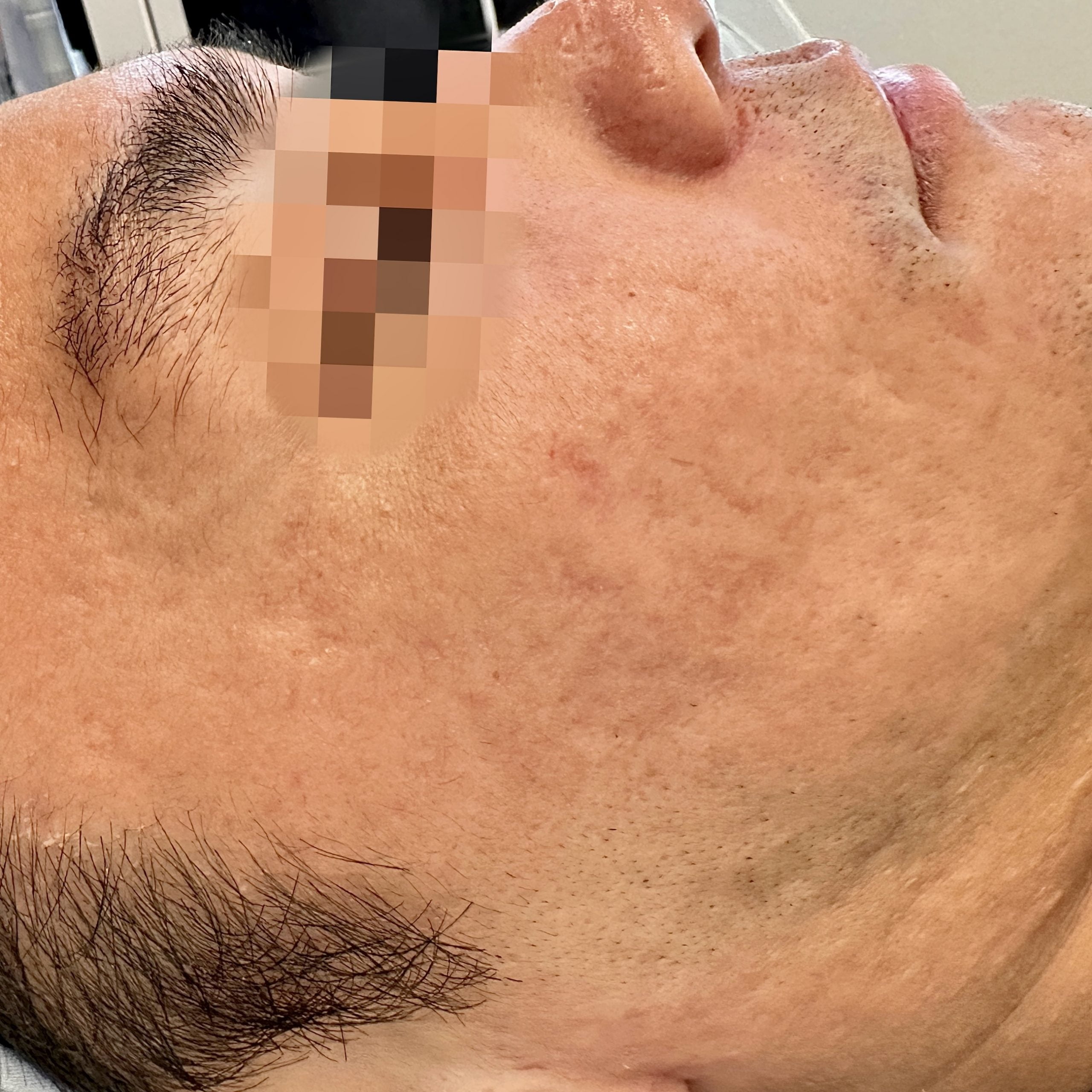 Client after 3 sessions of Venus Viva MD acne scar resurfacing.