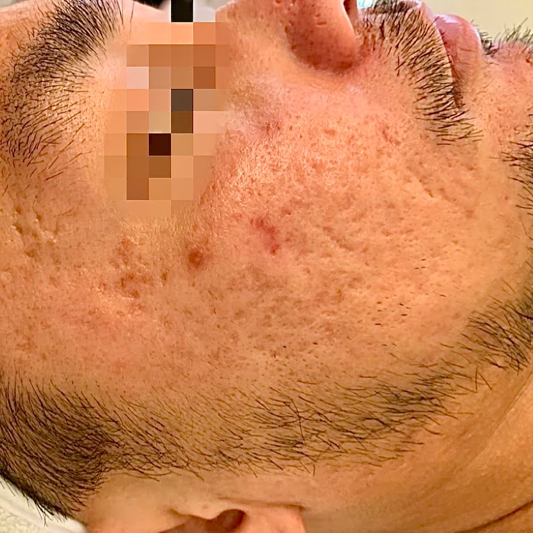 Client before Venus Viva MD acne scar resurfacing.