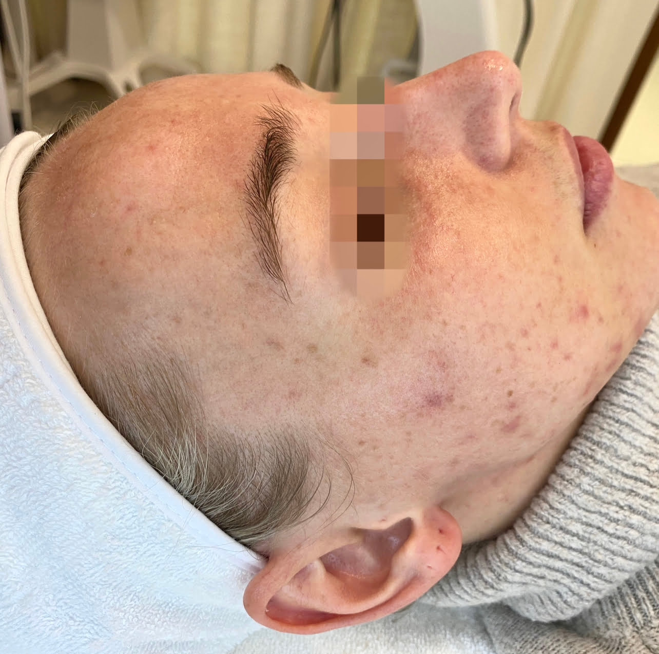 Client before Dermashine Meostherapy Acne Banish Injection