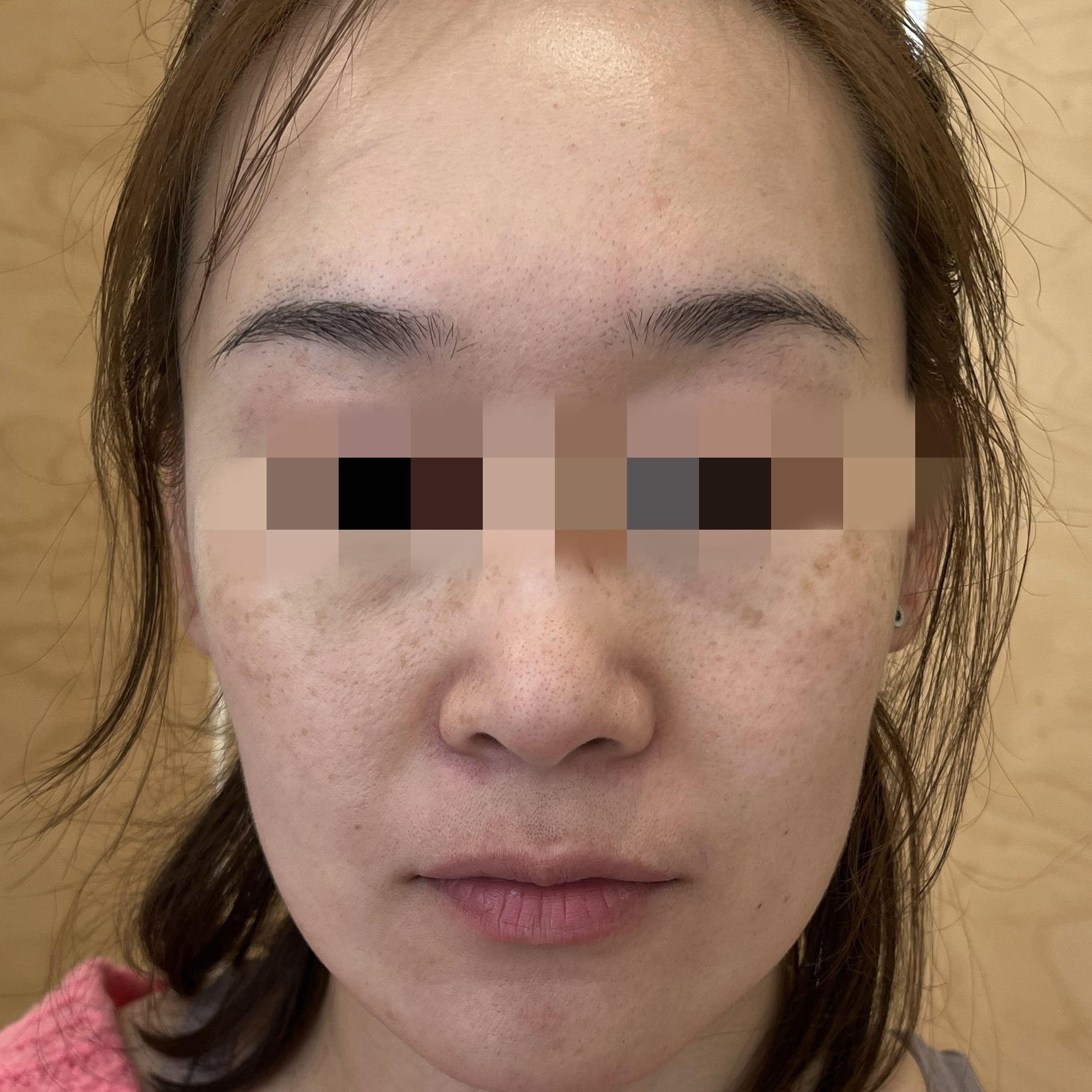 Before a Thermage FLX skin tightening treatment