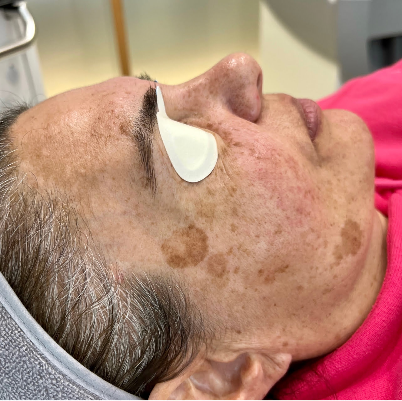 Client before PiQo4 Laser for face pigmentation.