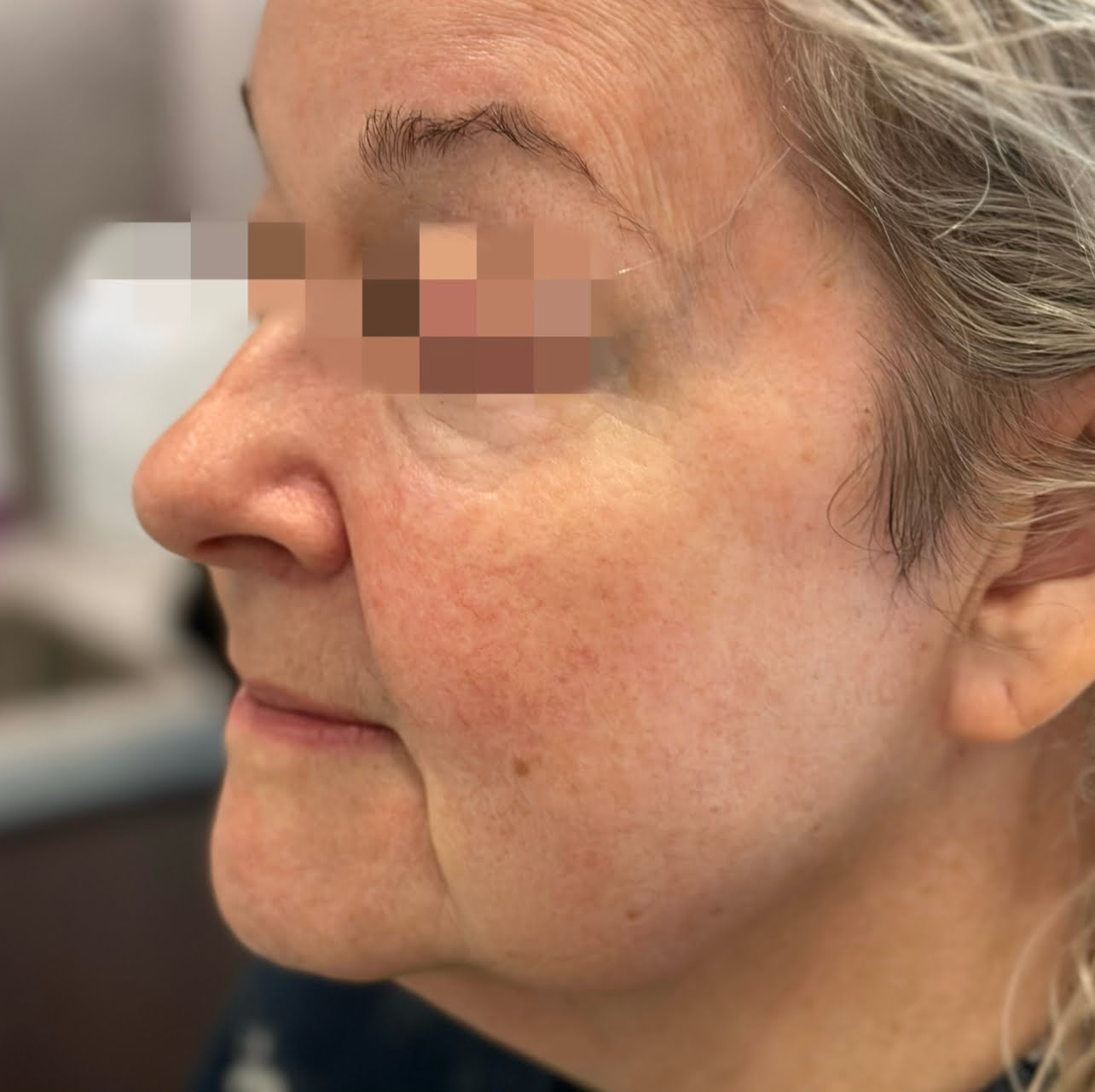 Client before Ultraformer III face lifting and tightening.