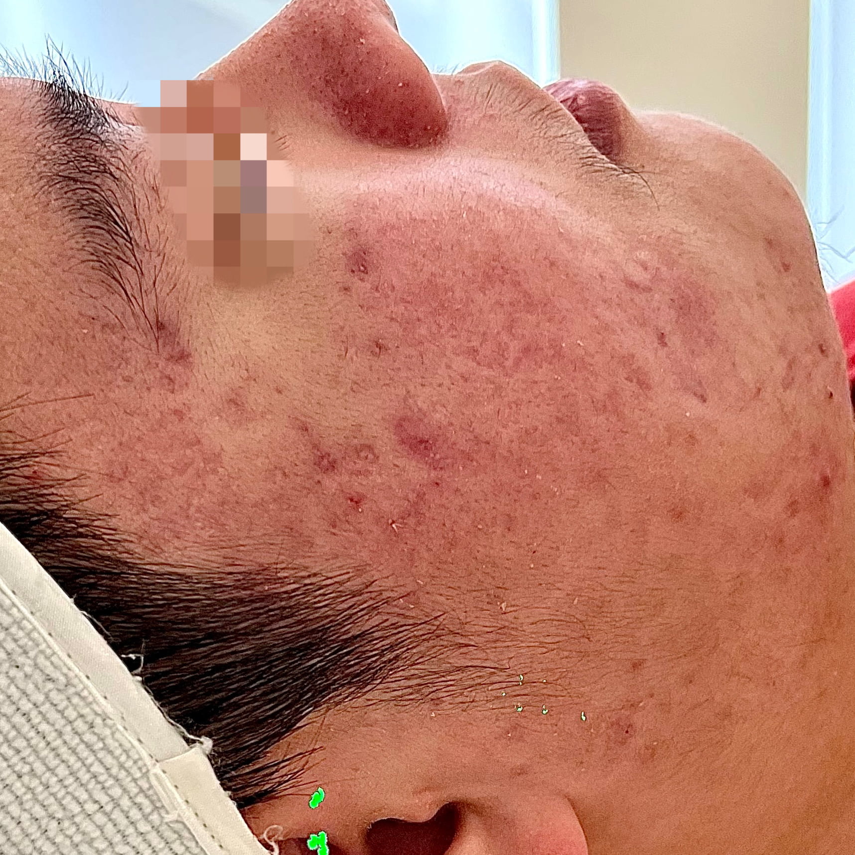 Client before Venus Viva acne scar resurfacing.