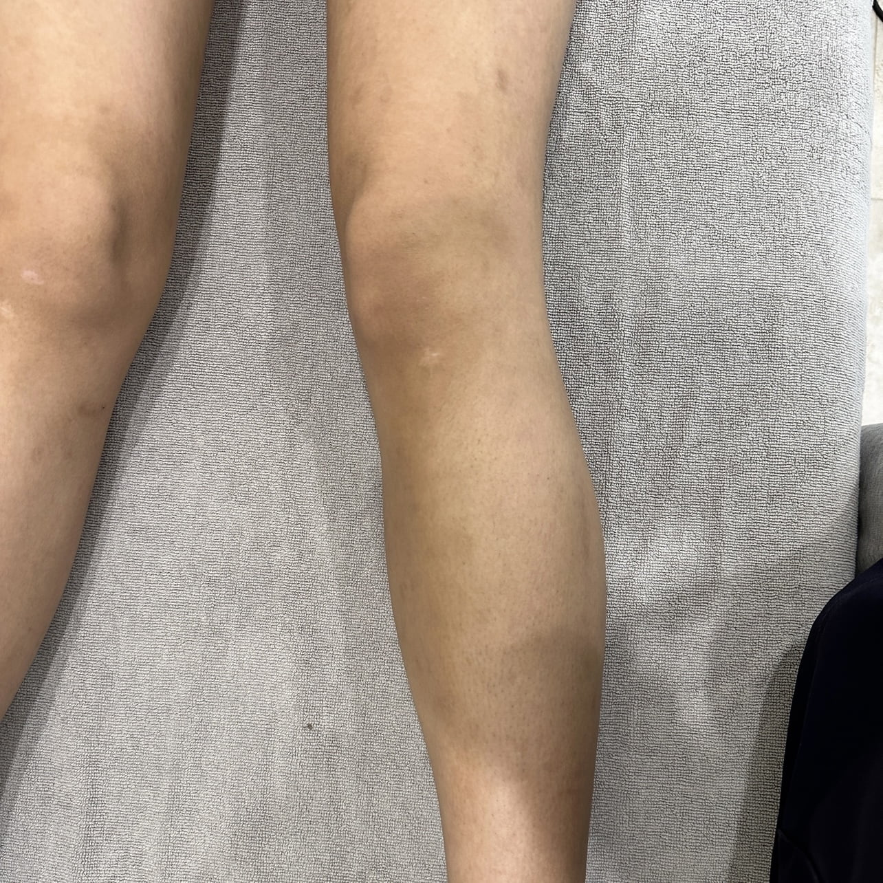 After 3 sessions of PiQo4 leg body Laser