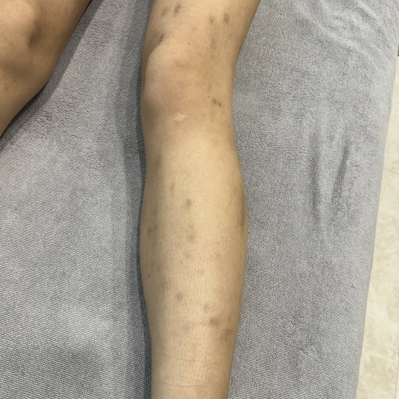Before 3 sessions of PiQo4 leg body Laser