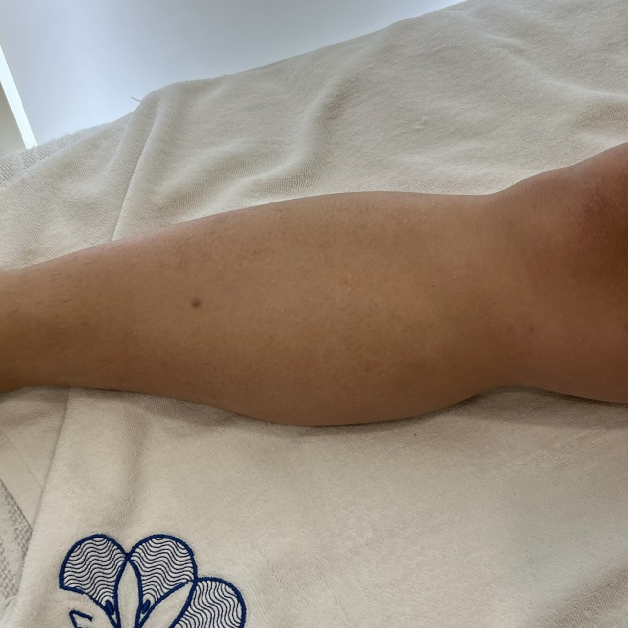 After 3 sessions of PiQo4 leg body Laser