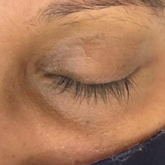 Client after 6 sessions of PiQo4 dark under eye laser.