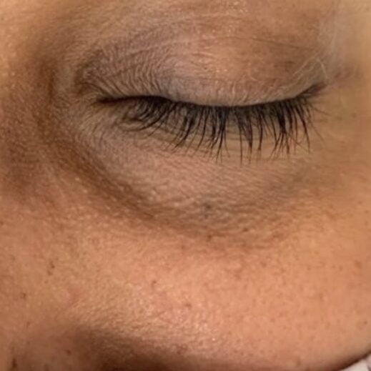 Client before PiQo4 dark under eye laser.