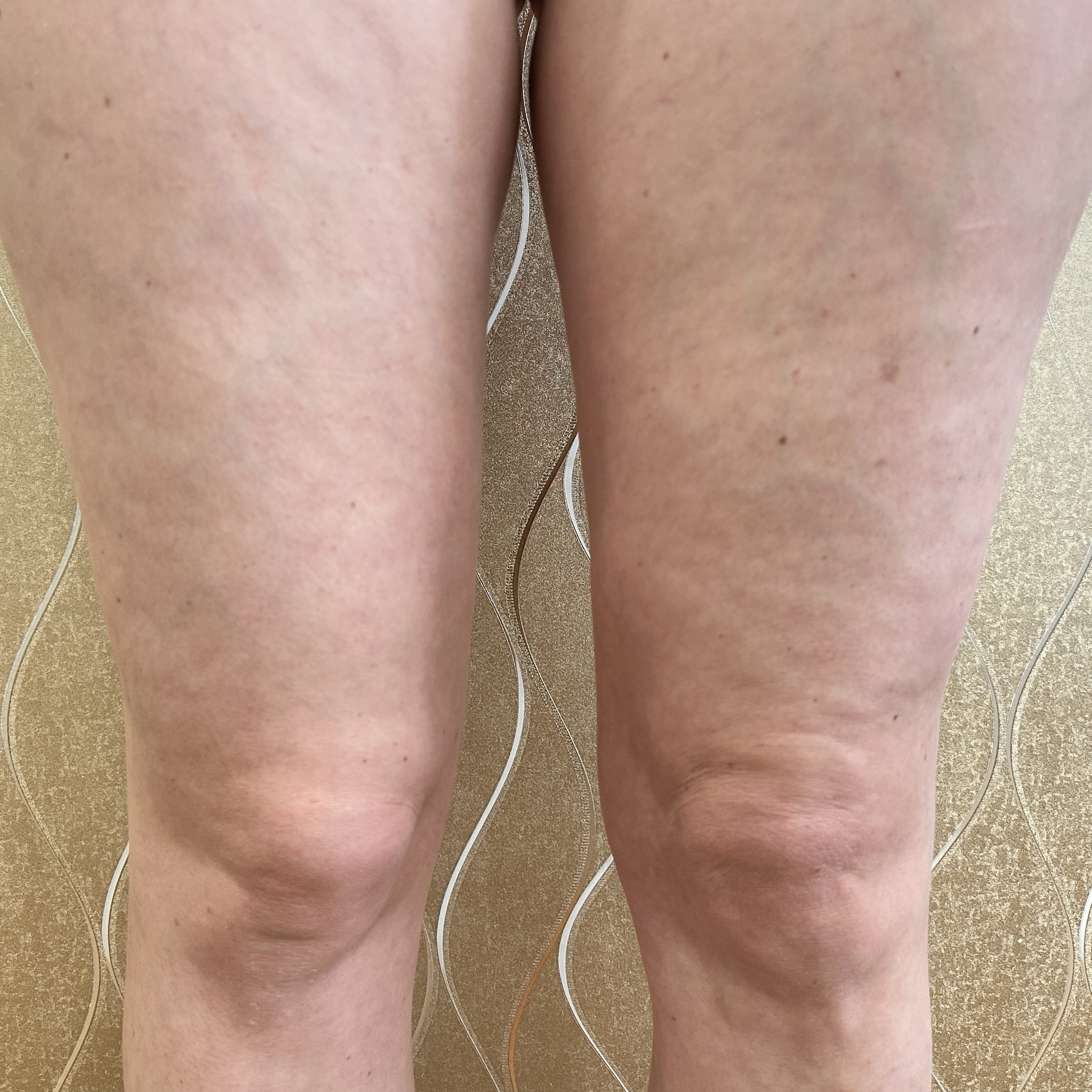 Client Before NuEra Cellulite Reduction