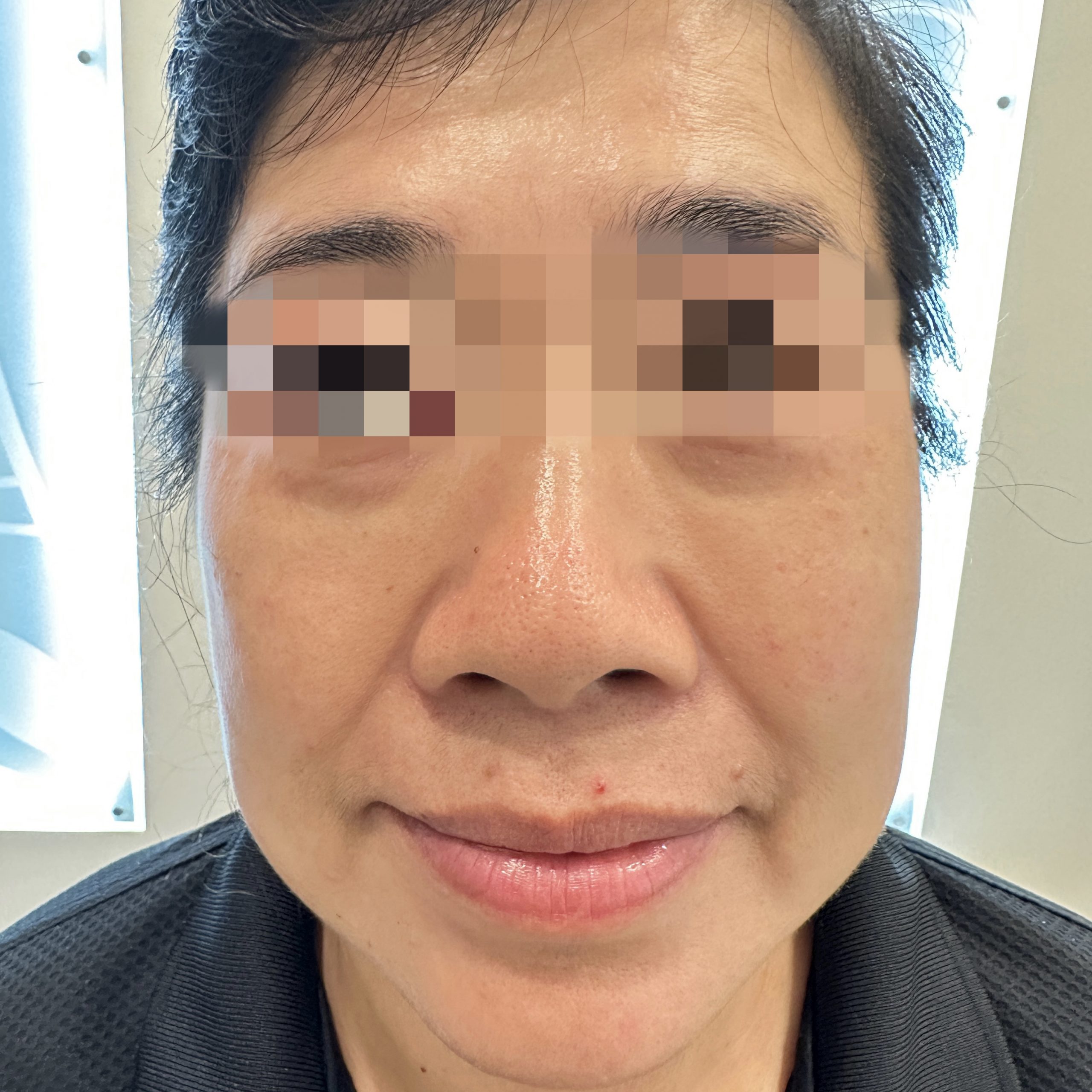 Client before Ultraformer III face lifting and tightening.