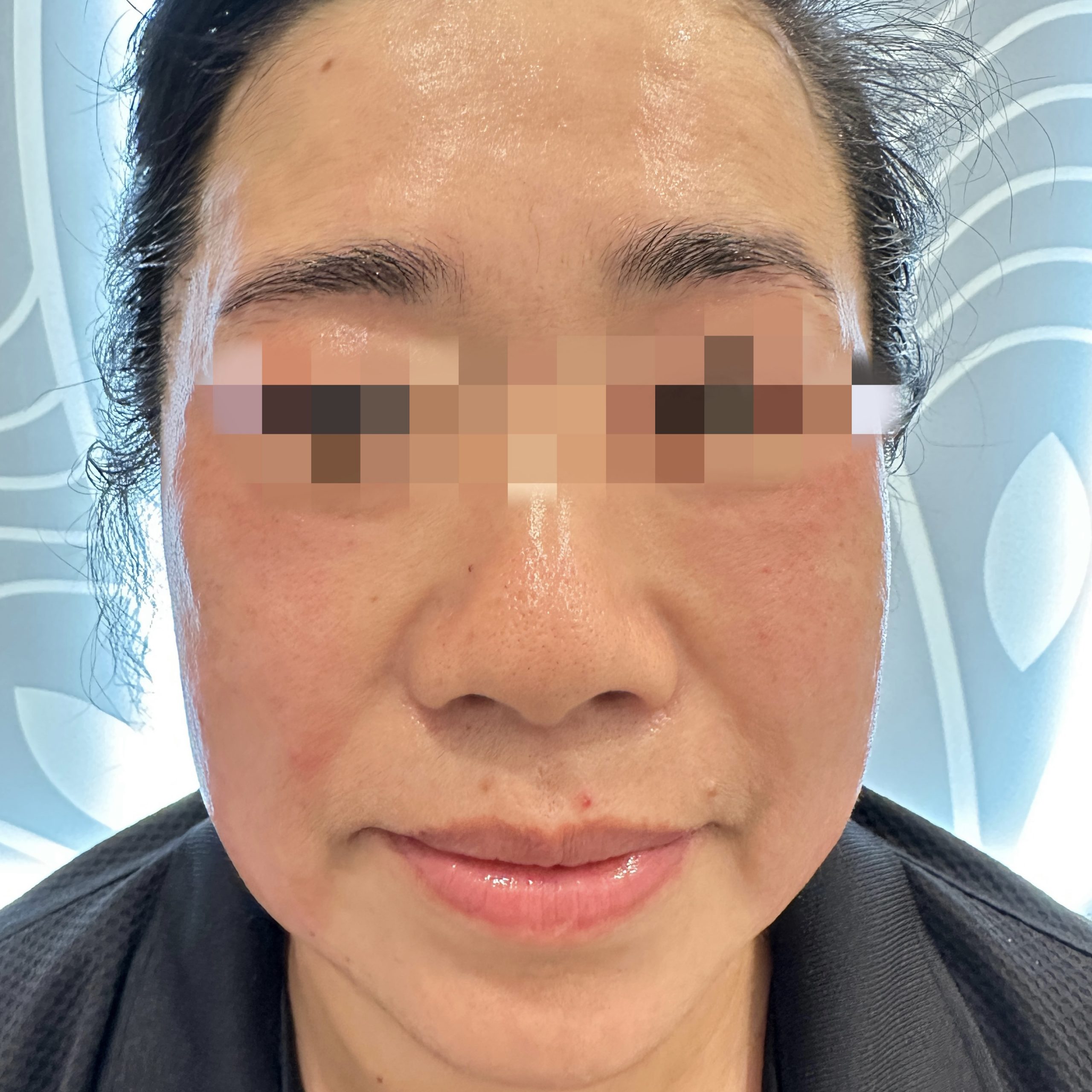 Client after Ultraformer III treatment, with tightened and lifted face and skin.