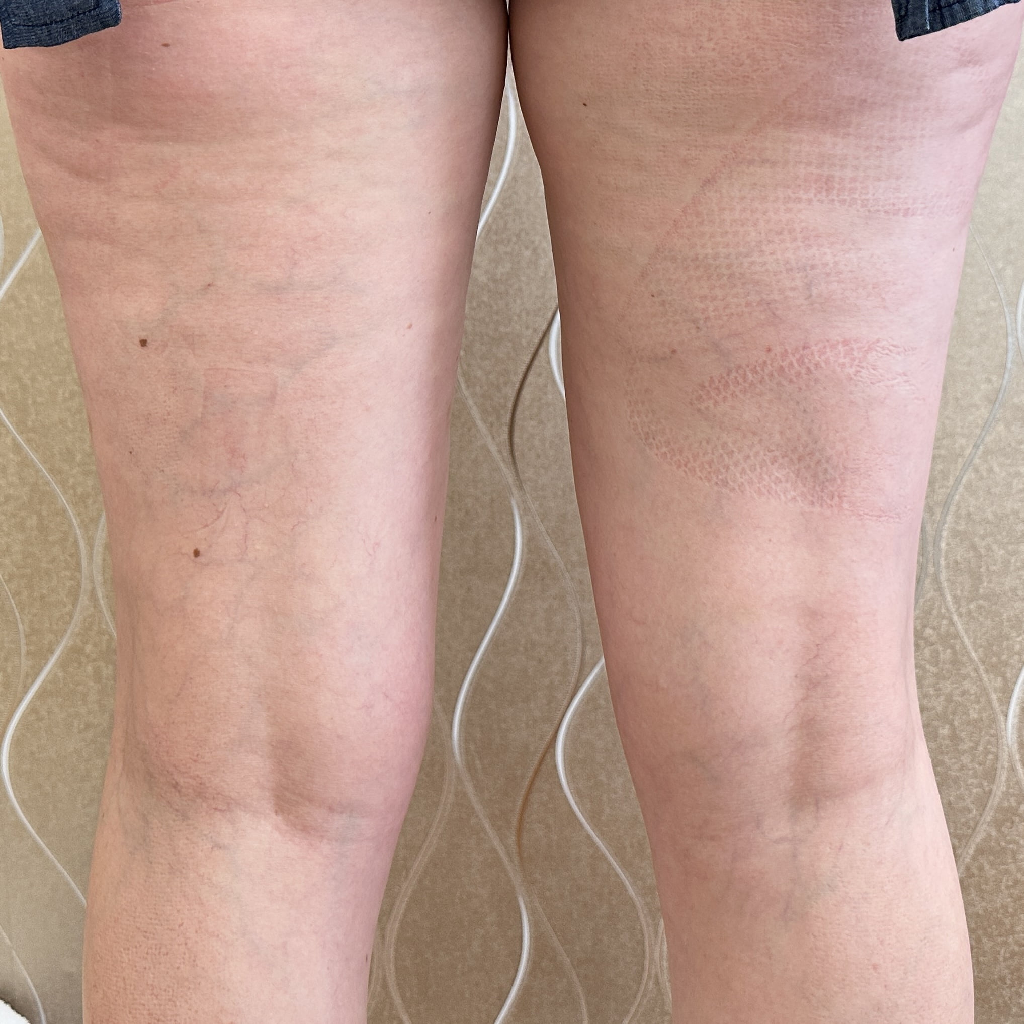 After 3 sessions of NuEra cellulite reduction