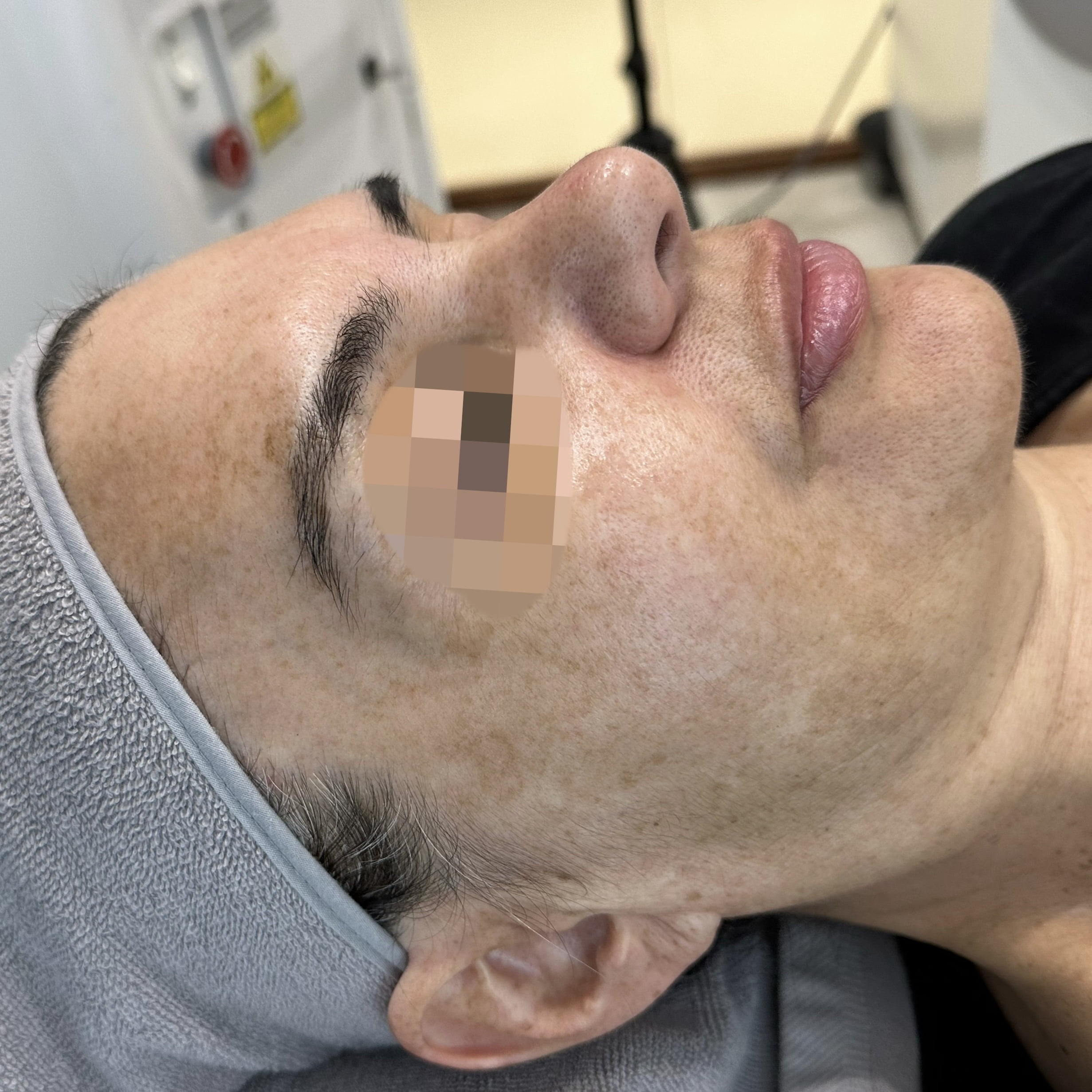 Client after 3 sessions PiQo4 Laser for face pigmentation.