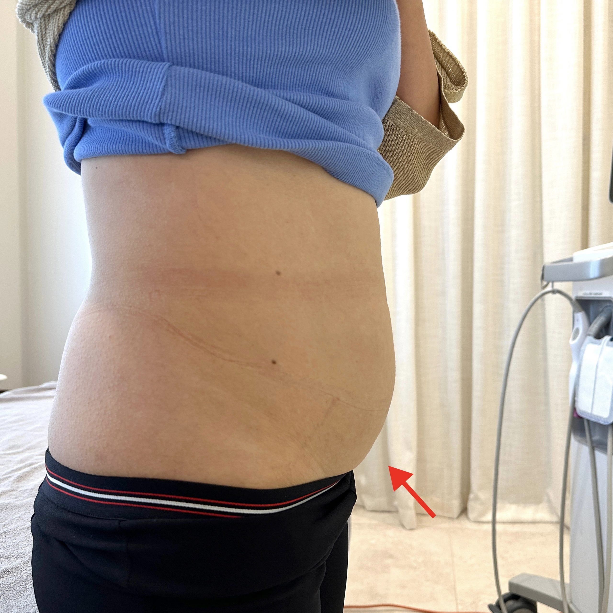 Before Thermage FLX body tightening for stomach