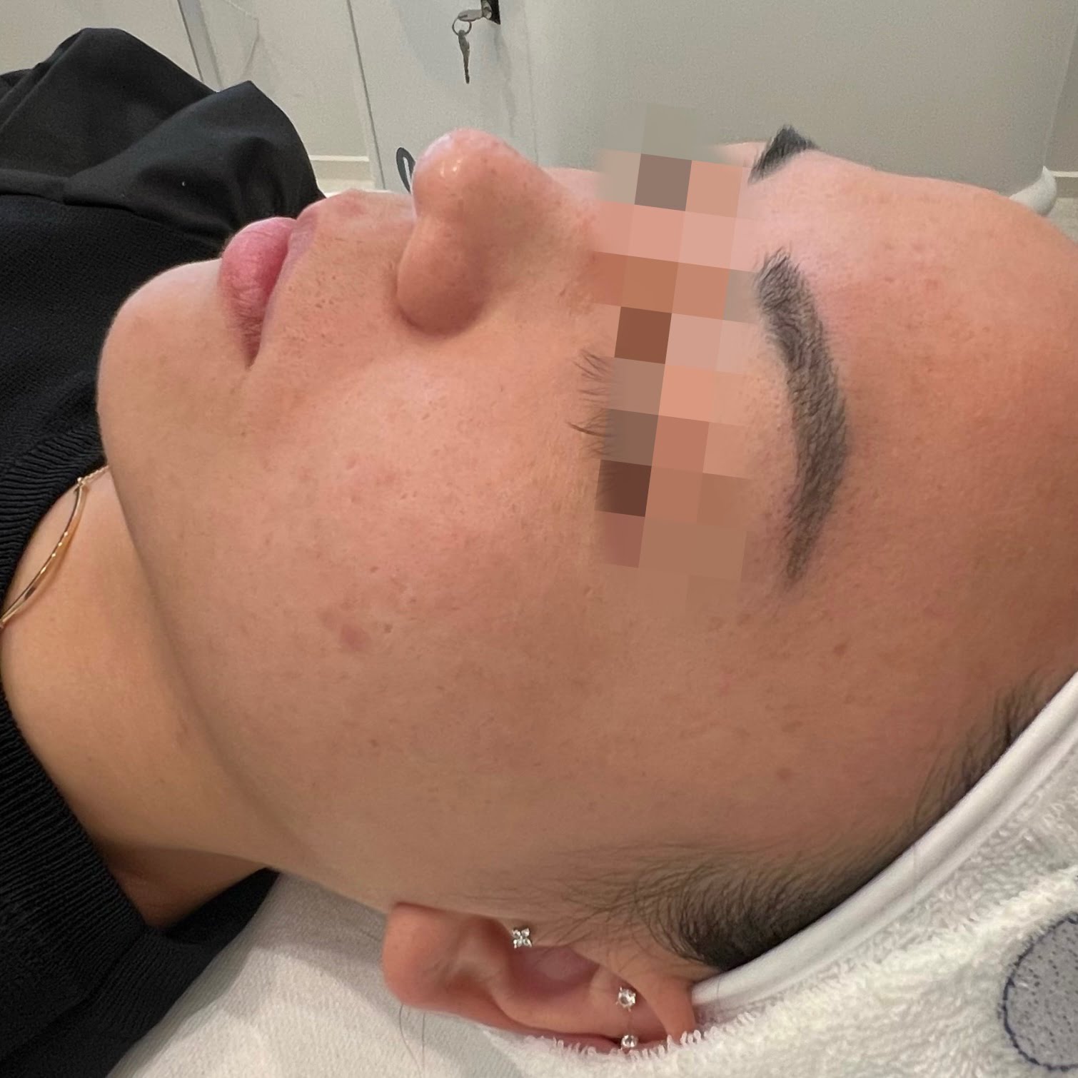 Client after 3 sessions PiQo4 Laser for face pigmentation.