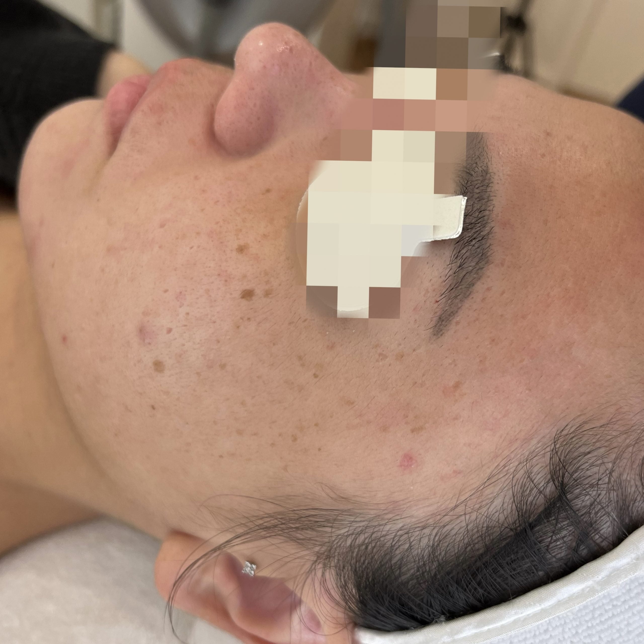Client before PiQo4 Laser for face pigmentation.
