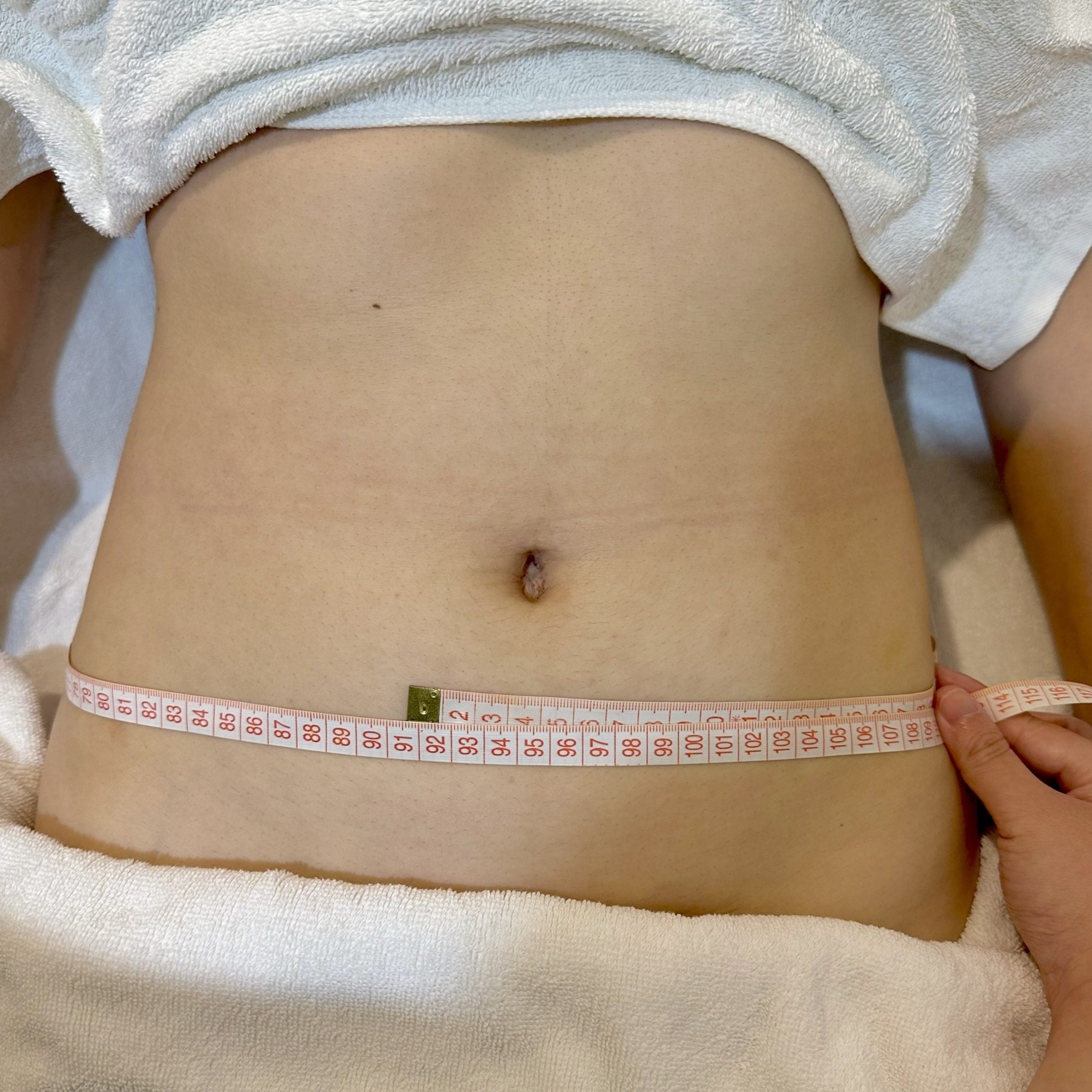 Client stomach before Coolshaping2 fat freezing.