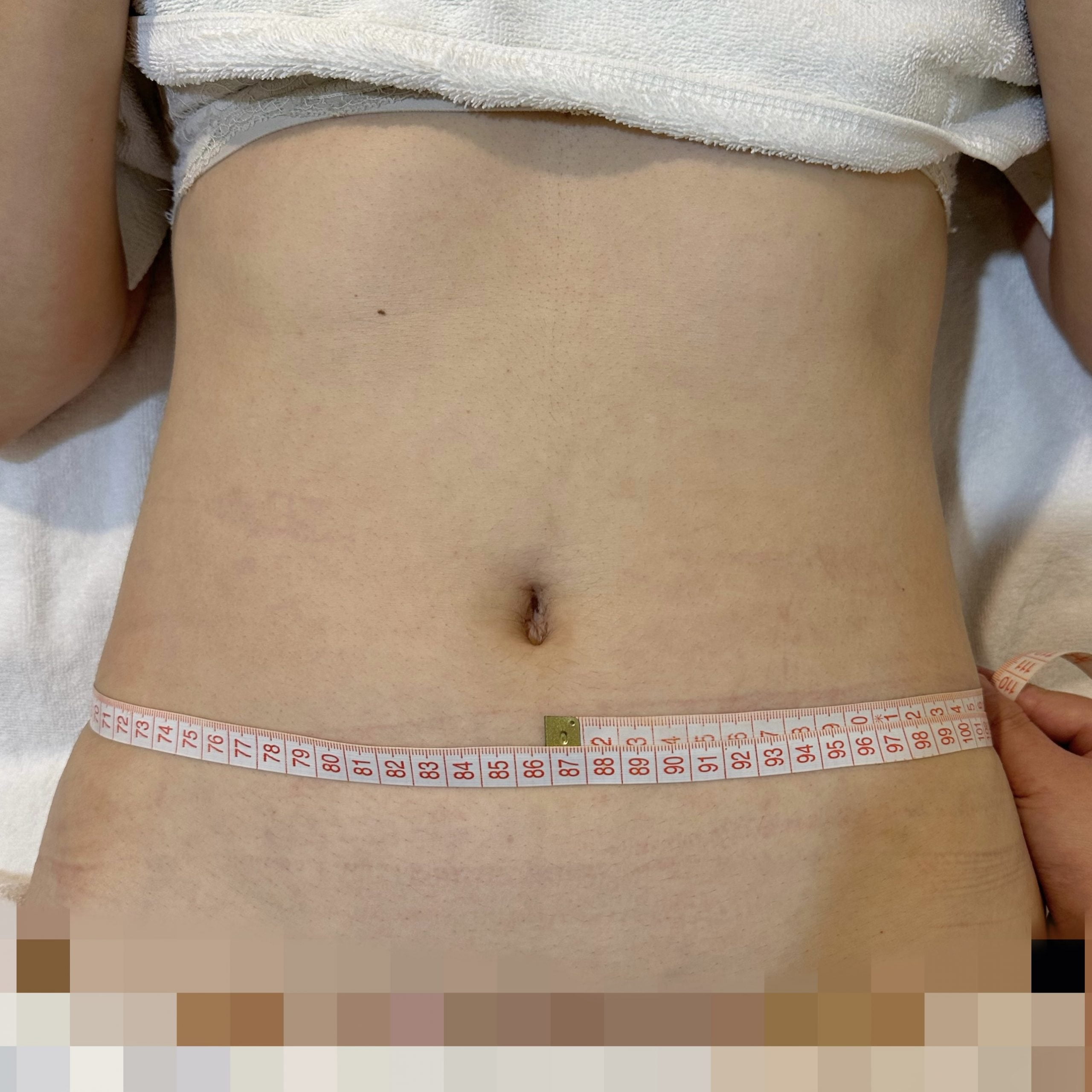 Clients stomach after 1 session Coolshaping2 fat freezing.