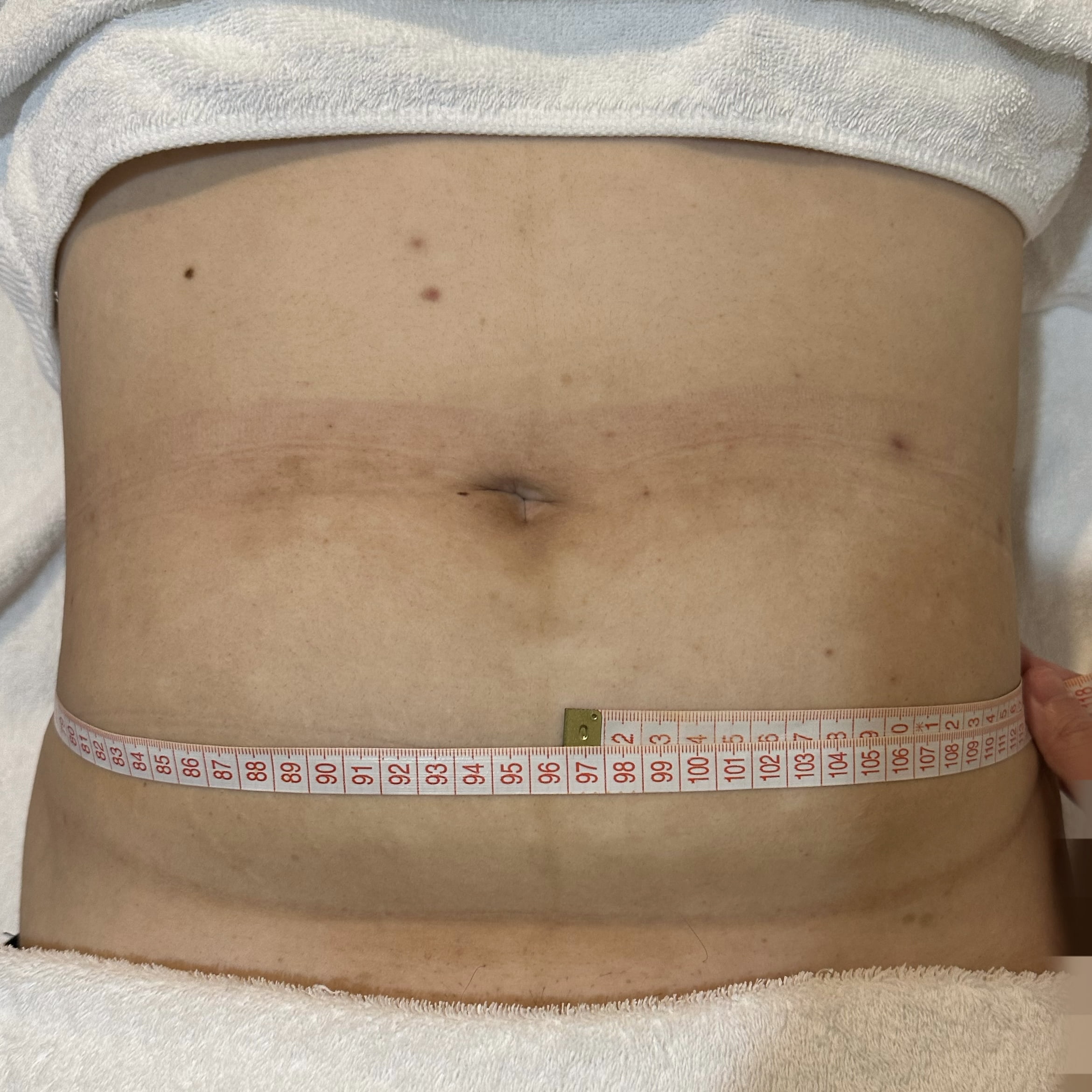 Clients stomach after 1 session Coolshaping2 fat freezing.