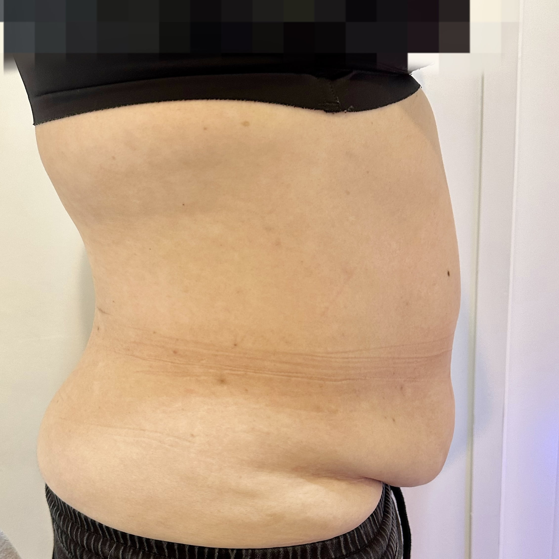 Client stomach before Coolshaping2 fat freezing.